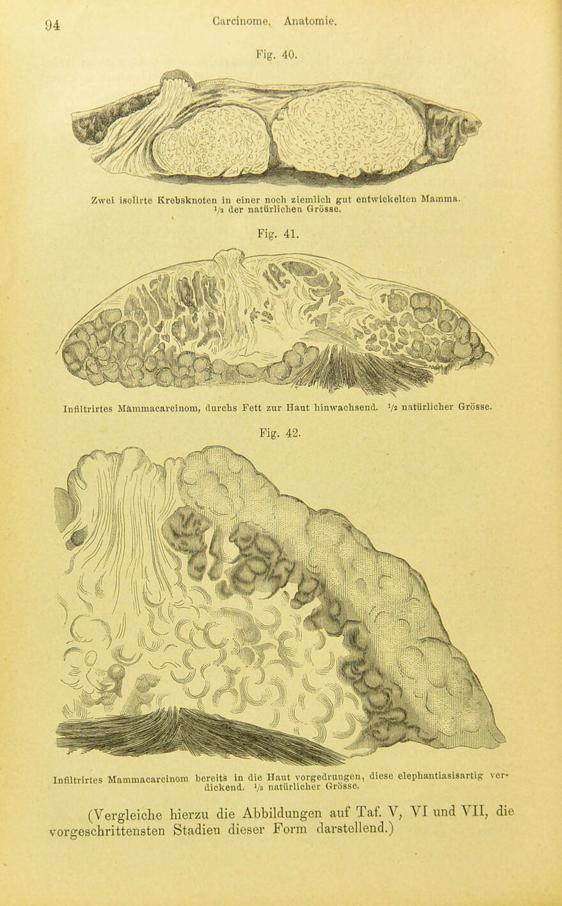 Fig. 40. Infiltrirtes Mämmacarcinom, durclis Fett zur Haut hinwachsend, '/ä natürlicher Grösse. Fig. 42. Infiltrirtes Mammacarcinom bereits in die Haut vorgedrungen, diese elephantiasisartig ver dicltend. V3 natürlicher Grösse. (Vergleiche hierzu die Abbildungen auf Taf. V, VI und VII, die vorgeschrittensten Stadien dieser Form darstellend.)