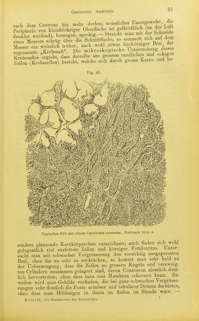 nach dem Ceutrum hin mehr derhes ^.«f ^^^^^f,^^^/?!rde; Luft Peripherie von kleinhöckriger Oberfläche ist gelbrothhch (an der dunklei werdend), homogen, speckig. - Streicht man mit der Schneide e nes Meisers schräg über die^ Schnittfläche, so sammelt sich auf dem Mes ei e n weisslich trüber, auch wohl etwas feinkörmger Brei dei ^genanl „Krebssaft«. Die mikroskopische Unters-W K?Pb.saftes ergiebt, dass derselbe aus grossen rundlichen und eckigen feÜ (£bÄ besteht, welche sich durch grosse Kerne und be- Typisches Bild aus einem Carcinoma mammae. Hartnack Syst. 5. sonders glänzende Kernkörperchen auszeichnen; auch finden sich wohl gelegentlich viel verfettete Zellen imd körniger Fettdetritus. Unter- sucht man mit schwacher Vergrösserung den vorsichtig ausgepressten Brei ohne ihn zu sehr zu zerdrücken, so kommt man sehr bald zu der Ueberzeugung, dass die Zellen zu grossen Kugeln und verzweig- ten Cylindern zusammen gelagert sind, deren Contouren ziemhch deut- lich hervortreten, ohne dass man eine Membran erkennen kann. Zu- weilen wird man Gebilde vorfinden, die bei ganz schwachen Vergrösse- rungen sehr deutlich die Form acinöser und tubulärer Drüsen darbieten, ohne dass man Höhlungen in ihnen zu finden im Stande wäre. — 7 Billroth, Die Krankheiten der Brustdrusen.
