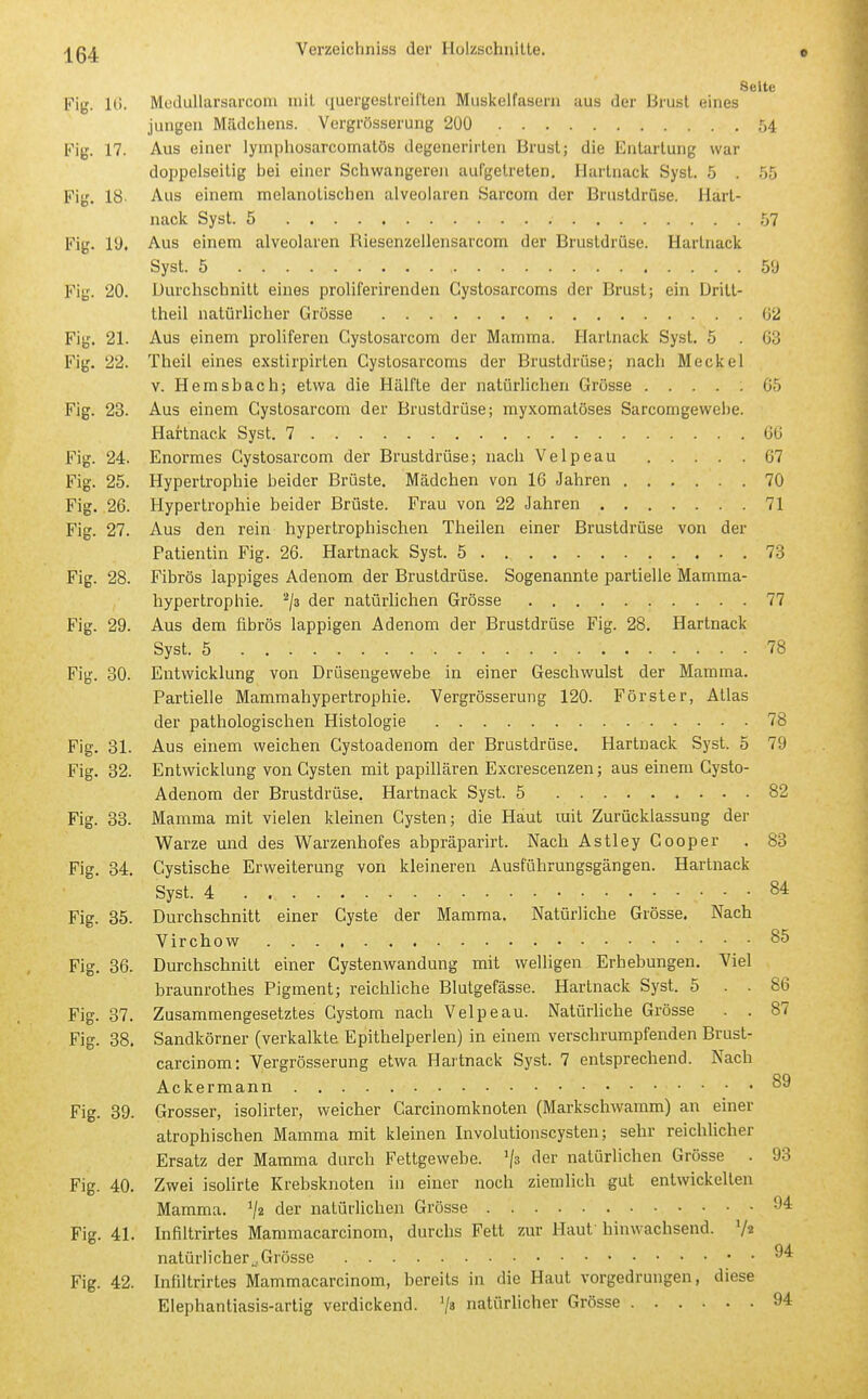 Seite Fig. Ki. MoiluUarsarcom mit (luergeBtreilteii Miiskelfasern aus der Brust eines jungen Mädcliens. Vergrösserung 200 54 Fig. 17. Aus einer lymphosarcomatös degenerirten Brust; die Entartung war doppelseitig bei einer Schwangeren aufgetreten, Ilartnack Syst. 5 . 55 Fig. 18 Aus einem melanotischen alveolaren Sarcorn der Brustdrüse. Hart- nack Syst. 5 57 Fig. lü. Aus einem alveolaren Riesenzellensarcom der Brustdrüse. Hartnack Syst. 5 59 Fig. 20. Durchschnitt eines proliferirenden Cystosarcoms der Brust; ein Dritt- theil natürlicher Grösse ü2 Fig. 21. Aus einem proliferen Cystosarcom der Mamma. Hartnack Syst. 5 . C3 Fig. 22. Theil eines exstirpirten Cystosarcoms der Brustdrüse; nach Meckel V. Hemsbach; etwa die Hälfte der natürlichen Grösse ..... 65 Fig. 23. Aus einem Cystosarcom der Brustdrüse; myxomatöses Sarcomgewehe. Hartnack Syst. 7 66 Fig. 24. Enormes Cystosarcom der Brustdrüse; nach Velpeau 67 Fig. 25. Hypertrophie beider Brüste, Mädchen von 16 Jahren 70 Fig. 26. Hypertrophie beider Brüste. Frau von 22 Jahren 71 Fig. 27. Aus den rein hypertrophischen Theilen einer Brustdrüse von der Patientin Fig. 26. Hartnack Syst. 5 73 Fig. 28. Fibrös lappiges Adenom der Brustdrüse. Sogenannte partielle Mamma- hypertrophie. '■'/a der natürlichen Grösse 77 Fig. 29. Aus dem fibrös lappigen Adenom der Brustdrüse Fig. 28, Hartnack Syst. 5 78 Fig. 30. Entwicklung von Drüsengewebe in einer Geschwulst der Mamma. Partielle Mammahypertrophie. Vergrösserung 120. Förster, Atlas der pathologischen Histologie 78 Fig. 31. Aus einem weichen Cystoadenom der Brustdrüse, Hartnack Syst. 5 79 Fig. 32. Entwicklung von Cysten mit papillären Excrescenzen; aus einem Cysto- Adenom der Brustdrüse, Hartnack Syst. 5 82 Fig. 33. Mamma mit vielen kleinen Cysten; die Haut rait Zurücklassung der Warze und des Warzenhofes abpräparirt. Nach AstleyCooper . 83 Fig. 34. Cystische Erweiterung von kleineren Ausführungsgängen. Hartnack Syst. 4 84 Fig. 35. Durchschnitt einer Cyste der Mamma. Natürliche Grösse. Nach Virchow 85 Fig. 36. Durchschnitt einer Cystenwandung mit welligen Erhebungen. Viel braunrothes Pigment; reichliche Blutgefässe. Hartnack Syst. 5 . . 86 Fig. 37. Zusammengesetztes Cystom nach Velpeau. Natürliche Grösse . . 87 Fig. 38. Sandkörner (verkalkte Epithelperlen) in einem verschrumpfenden Brust- carcinom: Vergrösserung etwa Hartnack Syst. 7 entsprechend. Nach Ackermann 89 Fig. 39. Grosser, isolirter, weicher Carcinomknoten (Markschwamm) an einer atrophischen Mamma mit kleinen Involutionscysten; sehr reichlicher Ersatz der Mamma durch Fettgewebe, /s fler natürlichen Grösse . 93 Fig. 40. Zwei isolirte Krebsknoten in einer noch ziemlich gut entwickelten Mamma. der natürlichen Grösse Fig. 41. Infiltrirtes Mammacarcinom, durchs Fett zur Haut' hinwachsend. natürlicher^. Grösse 9^ Fig. 42. Infiltrirtes Mammacarcinom, bereits in die Haut vorgedrungen, diese Elephantiasis-artig verdickend. '/» natürlicher Grösse 94