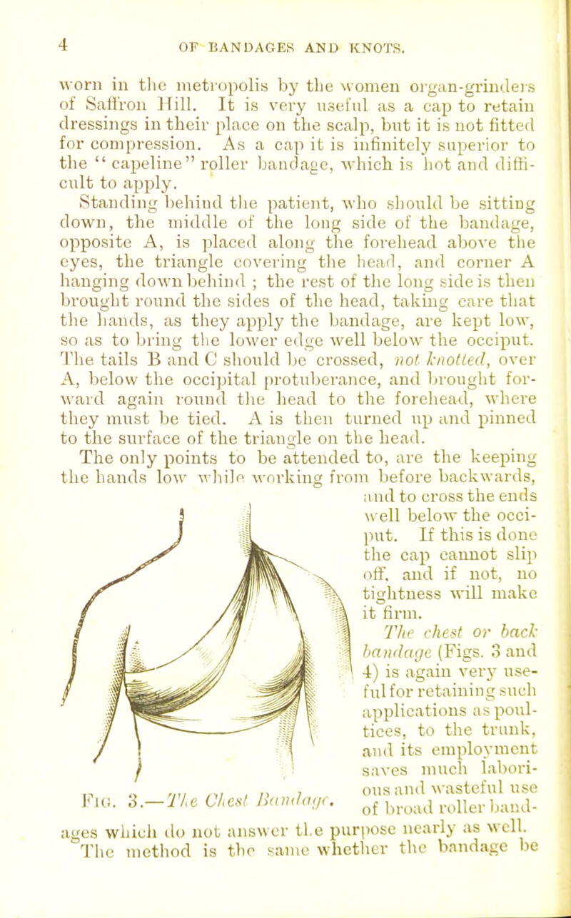 worn in the metropolis hy the women oigan-gmKleis of Salfron Hill. It is very n.sel'ul as a cap to retain dressings in their place on the scalp, but it is not fitted for compression. As a cap it is infinitely superior to the  capeline roller banclaj;e, which is hot and diffi- cult to apply. Standing behind tlie patient, who should be sitting down, the middle of the long side of the bandage, opposite A, is placed along the forehead above the eyes, the triangle covering the head, and corner A hanging down behind ; the rest of the long .side is then brought round the sides of the head, taking care that the hands, as they apply the bandage, are kept low, so as to bring the lower edge well below the occiput. The tails B and C should be crossed, not knotted, over A, below the occipital protuberance, and lirought for- ward again round the head to the forehead, whci'e they must be tied. A is then turned up and pinned to the surface of the triangle on the head. The only points to be attended to, are the keeping the hands low while working from before backwards, a nd to cross the ends well below the occi- put. If this is done the cap cannot slip off, and if not, no tightness will make it firm. The chest or back bandage (Figs. 3 and 4) is again verj' use- ful for retaining .such applications as poul- tices, to the trunk, and its employment saves much labori- ous and wasteful use of broad roller baud- ages which do not answer the purpose nearly as well. The method is the same whether the bandage l)e Fn;. 3.— Tie Chcul Ii(tndaij(.