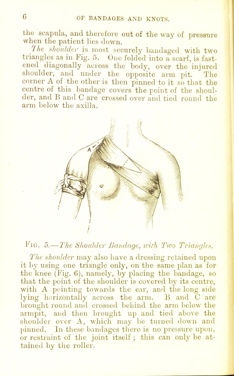 the scaijula, caud therefore out of the way of pressure when the patient lies down. llic t^lioiikhr is most securely bandaged with two triangles as in Fig. 5. Ojie folded into a scarf, is fast- ened diagonally across the body, over the injured shoulder, and under the opposite arm pit. The corner A of the other is then pinned to it so that the centre of this l)andage covers the point of the shoul- der, and B and C are crossed over and tied round the arm below the axilla. Fig. 5.—The Shouldtr Bandage, ici/h Two Triangles. The shoulder may also have a dressing retained upon it by using one triangle only, on the same plan as for the knee (Fig. G), namely, by placiug the bandage, so tliat the point of the shoulder is covered hy its centre, with A pointing towards the ear, and tlic long side lying horizontally across the arm. 13 and C are brouglit round and crossed behind the arm below the armpit, and then brought up and tied above the shoulder over A, which may be turned down and pinned. In tiiese b;uulages there is no pressure upon, or restraint of the joint itself ; this can only be at- tained by the roller.