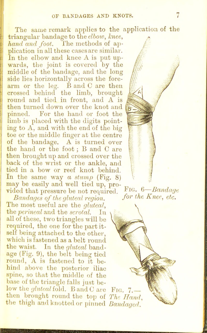 The same remark aj^plies to the application of the triangular bandage to the elbow, knee, />. hand and foot. The methods of aji- plication in all these cases are similar. In the elbow and knee A is put up- wards, the joint is covered by the middle of the bandage,, and the long side lies horizontally across the fore- arm or the leg. B and C are then crossed behind the limb, brought round and tied in front, and A is then turned down over the knot and pinned. For the hand or foot the limb is placed with the digits point- ing to A, and with the end of the big toe or the middle linger at the centre of the bandage. A is turned over the hand or the foot ; B and C are then brought up and crossed over the back of the wrist or the ankle, and tied in a bow or reef knot behind. In the same way a stwinp (Fig. 8) may be easily and well tied up, pro- vided that ijressure be not required. Baiidar/es of the glnteal region. The most useful are the r/lute,a/, the perineal and the scrotal. Ju all of these, two triangles will be required, the one for the part it- self being attached to the othei-, whicli is fastened as a belt round the waist. In the gliUeal band- age (Fig. 9), the belt being tied round, A is fastened to it be- hind above the posterior iliac spine, so that the middle of the base of tlio triangle falls just be- low tlie ijltUeal fold. B and C arc then br(night round the top of the thigh and knotted or pinned Bandaged. Fig. 6—Bandage for the Knee, etc.
