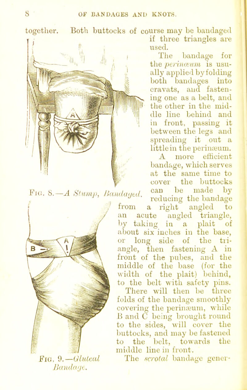 together. Fig, 9.—GliUeal IknuUi'jL. Both buttocks of coui'se may be bandaged if three triangles are used. The bandage for the periiuisinn is usu- ally applieil by folding both bandages into cravats, and fasten- ing one as a belt, aiid the other in the mid- dle line behind and in front, passing it between the legs and spreading it out a little in the perinasum. A more efficient bandage, wliich serves at the same time to cover the ljuttocks can be made hy reducing the bandage a riglit angled to an acute angled triangle, by taking in a plait of aljout six inches iu the base, or long side of the tri- angle, then fastening A in front of the pubes, and the middle of the base (for the width of the plait) behind, to the belt with safetj' pins. There will then be three folds of the bandage smoothly covering the perin:eum, while li and C being brouglit round to the sides, will cover tlie buttocks, and may be fastened to the belt, towards the middle line in front. The scrotal bandage gencr- Htnmji, llaiidaytd. ,' from