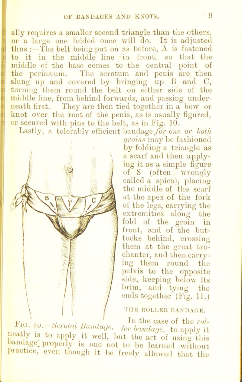 ally requires a smaller second triangle than tiie others, or a large one folded once will do. It is adjusted thus :—The belt being put on as before, A is fastened to it in the middle line in front, so that the middle of the base conies to the central point of the perinaium. The scrotum and penis are then slung u]3 and covered by bringing up B and C, turning them round the belt on either side of the middle line, from behind forwards, and passing under- neath first. They are then tied together in a bow or knot over the root of the penis, as is usually figured, or secured with pins to the belt, as in Fig. 10. Lastly, a tolerably elficient bandage for one or holli grolnti may be fashioned by folding a triangle as a scarf and then apply- ing it as a simple figiire of 8 (often wi'ongly called a spica), placing the middle of the scarf at the apex of the fork of the legs, carrj'ing the extremities along the fold of the groin in front, and of the but- tocks behind, crossing them at the great tro- chanter, and then carry- ing them round the pelvis to the opposite side, keeping below its brim, and tying tlie ends together (Fig. 11.) •run KOLLKR BANDAOE. I, ^. , , ,, , In the case of the ro/- l^^.^bcrotaL Lcunlwje. /„■ handa./e, to apply it neatly ,s to apply it well, but the art of using tliis OanUage. properly is one not to be learned without practice, even though it bo fre.-lv allowed th;it the Fj.i.