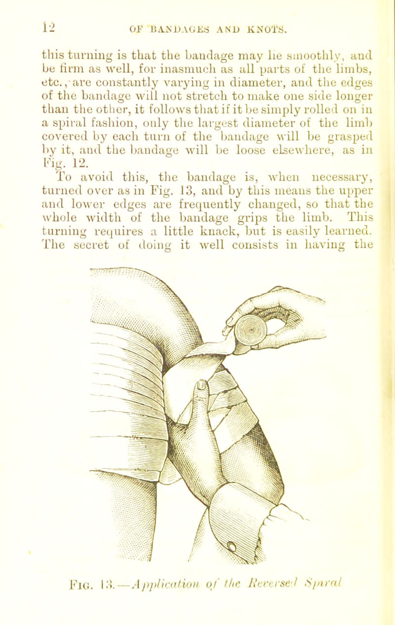 this turning is that the bandage may lie smoothly, aud be tii'm as well, for inasmuch as all parts of the limbs, etc., are constantly varying in diameter, and the edges of the bandage will not stretch to make one side longer than the otlier, it follows that if it be simply rolled on in a spiral fashion, only the largest diameter of the limb covered Ijy each turn of the bandage ^^■ill be grasped by it, and the bandage will be loose elsewhere, as in To avoid this, the bandage is, when necessary, turned over as in Fig. 13, and by this means the upper and lower edges are frequently changed, so that the whole width of the bandage grips the limb. This turning requires a little knack, but is easily learned. The secret of doing it well consists in having the Fit;. ['■'<■—A jii>lic(tlioii u/ llii' Ni-nrse-l S/nral