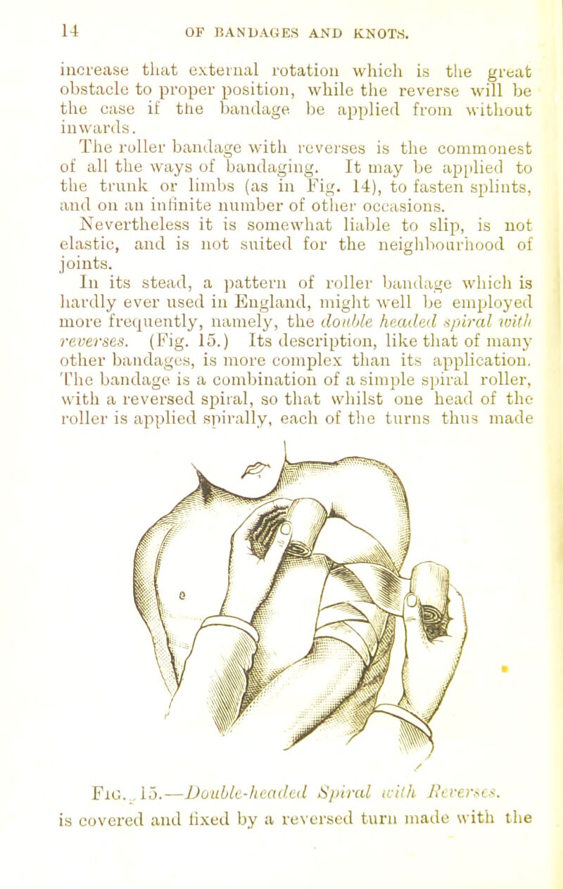 increase tliat external rotation which is the great obstacle to proper position, while the reverse will be the case if the bandage be applied from witlioiit inwards. Tlie roller bandage with reverses is the commonest of all the ways of bandaging. It may be ap[ilied to the trunk or limbs (as in Fig. 14), to fasten splints, and on an inlinite number of other occasions. Nevertheless it is somewhat liable to slip, is not elastic, and is not suited for the neighlioiirhood of joints. In its stead, a pattern of roller bandage wliich is hardly ever used in England, miglit M'ell be employed more frequently, namely, the double, headed spiral with reverses. (Fig. 15.) Its description, like that of manj' other bandages, is more comjjlex than its application. The bandage is a combination of a simple s])iral roller, with a reversed si^iial, so that whilst one head of the roller is applied spirally, each of the turns thus made Fig.,, 15.—Double-headed Spiral icilh J\eversc.<. is covered and lixed by a reversed turn matle with tlie
