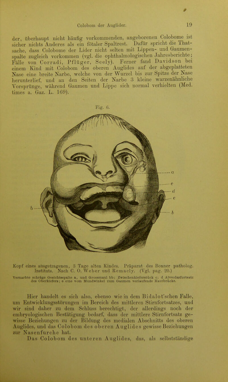 der, überhaupt nicht häufig vorkommenden, angeborenen Colobome ist sicher nichts Anderes als ein fötaler Spaltrest. Dafür spricht die That- sache, dass Colobome der Lider nicht selten mit Lippen- und Gaumen- spalte zugleich vorkommen (vgl. die ophthalmologischen Jahresberichte; Fälle von Corradi, Pflüger, Seely). Ferner fand Davidson bei einem Kind mit Colobom des oberen Auglides auf der abgeplatteten Nase eine breite Narbe, welche von der Wurzel bis zur Spitze der Nase herunterlief, und an den Seiten der Narbe 3 kleine warzenähnliche Vorsprünge, während Gaumen und Lippe sich normal verhielten (Med. times a. Gaz. L. 169). Kopf eines aüsgetragenen, 3 Tage alten Kindes. Präparat des Bonner patholog. Instituts. Nach C. 0. Weber und Remacly. (Vgl. pag. 20.) Vernarbte schräge Gesiohtsspalte a, und Grossmaul bb; Zwischenkieferstück c; d Alveolarfortsatz des Oberkiefers; e eine vom Mundwinkel zum Gaumen verlaufende Hautbrücke. Hier handelt es sich also, ebenso wie in dem Bidalot'schen Falle, um Entwicklungsstörungen im Bereich des mittleren Stirnfortsatzes, und -wir sind daher zu dem Schluss berechtigt, der allerdings noch der embryologischen Bestätigung bedarf, dass der mittlere Stirnfortsatz ge- wisse Beziehungen zu der Bildung des medialen Abschnitts des oberen Auglides, und das Colobom des oberen Auglides gewisse Beziehungen zur Nasenfurche hat. Das Colobom des unteren Auglides, das, als selbstständige