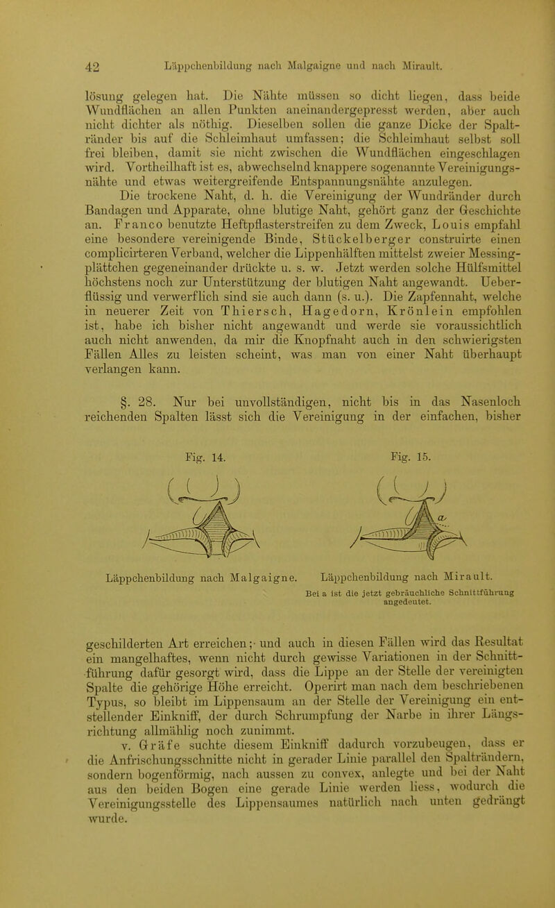 lösuug gelegen hat. Die Nähte müssen so dicht liegen, dass beide Wundflächen an allen Punkten aneinandergepresst werden, aber auch nicht dichter als nöthig. Dieselben sollen die ganze Dicke der Spalt- ränder bis auf die Schleimhaut umfassen; die Schleimhaut selbst soll frei bleiben, damit sie nicht zwischen die Wundflächen eingeschlagen wird. Vortheilhaft ist es, abwechselnd knappere sogenannte Vereinigungs- nähte und etwas weitergreifende Entspannungsnähte anzulegen. Die trockene Naht, d. h. die Vereinigung der Wundränder durch Bandagen und Apparate, ohne blutige Naht, gehört ganz der Geschichte an. Fr an CO benutzte Heftpflasterstreifen zu dem Zweck, Louis empfahl eine besondere vereinigende Binde, Stückelb erger construirte einen compliciiieren Verband, welcher die Lippenhälften mittelst zweier Messing- plättchen gegeneinander drückte u. s. w. Jetzt werden solche Hülfsmittel höchstens noch zur Unterstützung der blutigen Naht augewandt. Ueber- flüssig und verwerflich sind sie auch dann (s. u.). Die Zapfennaht, welche in neuerer Zeit von Thierseh, Hagedorn, Krönlein empfohlen ist, habe ich bisher nicht angewandt und werde sie voraussichtlich auch nicht anwenden, da mir die Knopfnaht auch in den schwierigsten Fällen Alles zu leisten scheint, was man von einer Naht überhaupt verlangen kann. §. 28. Nur bei unvollständigen, nicht bis in das Nasenloch reichenden Spalten lässt sich die Vereinigung in der einfachen, bisher Fig. 14. Fig. 15. Läppchenbildung nach Malgaigne. Läppchenbildung nach Mirault. Bei a Ist die jetzt gebräuclillclie Schnittführung angedeutet. geschilderten Art erreichen;- und auch in diesen Fällen wird das Resultat ein mangelhaftes, wenn nicht durch gewisse Variationen in der Schnitt- führung dafür gesorgt wird, dass die Lippe an der Stelle der vereinigten Spalte die gehörige Höhe erreicht. Operii't man nach dem beschi-iebenen Typus, so bleibt im Lippensaum an der Stelle der Vereinigung ein ent- stellender Einkniff, der durch Schrumpfung der Narbe in ihrer Längs- richtung allmählig noch zunimmt. V. Gräfe suchte diesem Einkniff dadurch vorzubeugen, dass er die Anfrischungsschnitte nicht in gerader Linie parallel den Spalträndern, sondern bogenförmig, nach aussen zu convex, anlegte und bei der Naht aus den beiden Bogen eine gerade Linie werden Hess, wodurch die Vereinigungsstelle des Lippensaumes natürlich nach unten gedrängt wurde.