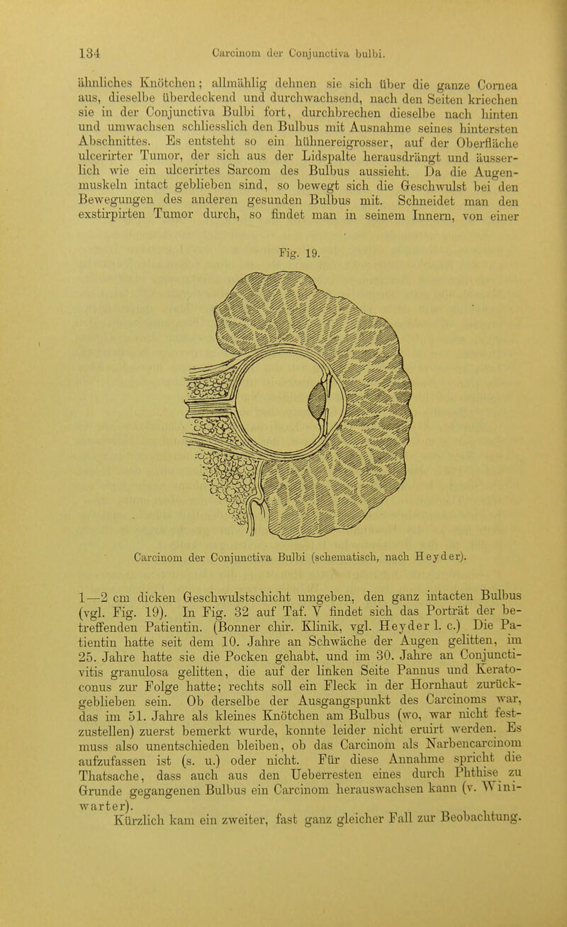 ähnliches Knötchen; alhnählig dehnen sie sich über die ganze Cornea aus, dieselbe überdeckend und durchwachsend, nach den Seiten kriechen sie in der Conjunctiva Bulbi fort, durchbrechen dieselbe nach hinten und umwachsen schliesslich den Bulbus mit Ausnahme seines hintersten Abschnittes. Es entsteht so ein hühnereigrosser, auf der Obei-fläche ulcerh-ter Tumor, der sich aus der Lidspalte herausdrängt und äusser- lich wie ein ulcerirtes Sarcom des Bulbus aussieht. Da die Augen- muskeln intact geblieben sind, so bewegt sich die Geschwulst bei den Bewegungen des anderen gesunden Bulbus mit. Schneidet man den exstirpirten Tumor durch, so findet man in seinem Innern, von einer Fig. 19. Carcinom der Conjunctiva Bulbi (scliematisch, nach Hey der). 1—2 cm dicken Geschwulstschicht umgeben, den ganz intacteu Bulbus (vgl. Fig. 19). In Fig. 32 auf Taf. V findet sich das Porträt der be- treffenden Patientin. (Bonner chir. Klinik, vgl. Hey der 1. c.) Die Pa- tientin hatte seit dem 10. Jahre an Schwäche der Augen gelitten, im 25. Jahre hatte sie die Pocken gehabt, und im 30. Jahre an Conjuncti- vitis granulosa gelitten, die auf der linken Seite Pannus und Kerato- conus zur Folge hatte; rechts soll ein Fleck in der Hornhaut zurück- geblieben sein. Ob derselbe der Ausgangspunkt des Carcinoms war, das im 51. Jahre als kleines Knötchen am Bulbus (wo, war nicht fest- zustellen) zuerst bemerkt wurde, konnte leider nicht eruirt werden. Es muss also unentschieden bleiben, ob das Carcinom als Narbencarcinom aufzufassen ist (s. u.) oder nicht. Für diese Annahme spricht die Thatsache, dass auch aus den Ueberresten eines durch Phthise zu Grunde gegangenen Bulbus ein Carcinom herauswachsen kann (v. Wini- Avarter). Kürzlich kam ein zweiter, fast ganz gleicher Fall zur Beobachtung.