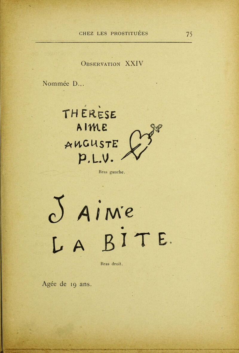 Observation XXIV Nommée D... TH EReSE Aime p,LV. Bras gauche c5 A Bras droit. Agée de 19 ans.