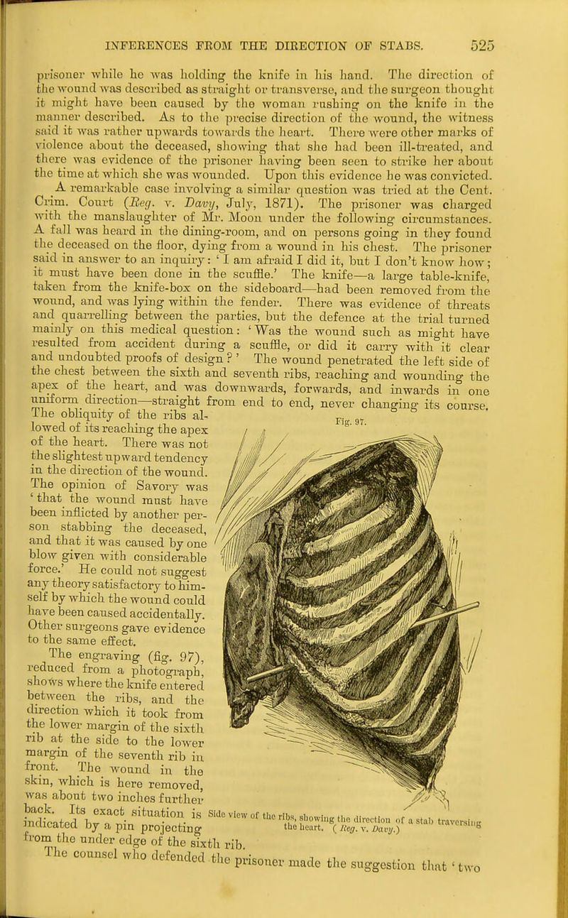 prisoner while he was holding the knife in his hand. The dix-ection of the wound was described as straight or transverse, and the surgeon thought it might have been caused by the woman rushing on the knife in the manner described. As to the precise direction of the wound, the witness said it wi^s rather upwards towards the heart. There were other marks of violence about the deceased, showing that she had been ill-ti-eated, and there was evidence of the prisoner having been seen to strike her about the time at which she was wounded. Upon this evidence he was convicted. _ A remarkable case involving a similar question was tried at the Cent. Crim. Court (Beg. v. Davy, July, 1871). The prisoner was charged with the manslaughter of Mr. Moon under the following cii'Cumstances. A fall was beard in the dining-room, and on persons going in they found the deceased on the floor, dying from a wound in his chest. The prisoner said in answer to an inquiry: ' I am afi-aid I did it, but I don't know how; it must have been done in the scuffle.' The knife—a large table-knife, taken from the knife-box on the sideboard—had been removed from the wound, and was lying within the fender. There was evidence of threats and quaii-elling between the parties, but the defence at the trial turned mainly on this medical question: ' Was the wound such as might have resulted from accident during a scuffle, or did it carry with^'it clear and undoubted proofs of design ? ' The wound penetrated the left side of the chest between the sixth and seventh ribs, reaching and wounding the apex of the heart, and was downwards, forwards, and inwards in one uniform direction—straight from end to end, never changing its course ihe obliquity of the ribs al- p. lowed of its reaching the apex of the heart. There was not the slightest upward tendency in the direction of the wound. The opinion of Savory was ' that the wound must have been inflicted by another per- son stabbing the deceased, and that it was caused by one blow given with considerable force.' He could not suggest any theory satisfactory to him- self by which the wound could have been caused accidentally. Other surgeons gave evidence to the same effect. The engraving (fig. 97), reduced from a photograph, shows where the knife entered between the ribs, and the direction which it took from the lower margin of the sixth rib at the side to the lower margin of the seventh rib in front. The wound in the skin, which is here removed, was about two inches further back. Its exact situation is indicated by a pin projecting from the under edge of the sixth rib The counsel who defended the prisoner made the suggestion that 'two SMo view of the ribs showing ,I,o direction of a stal, traversing tlie beurt. ( /leg. v. Davij.) ^