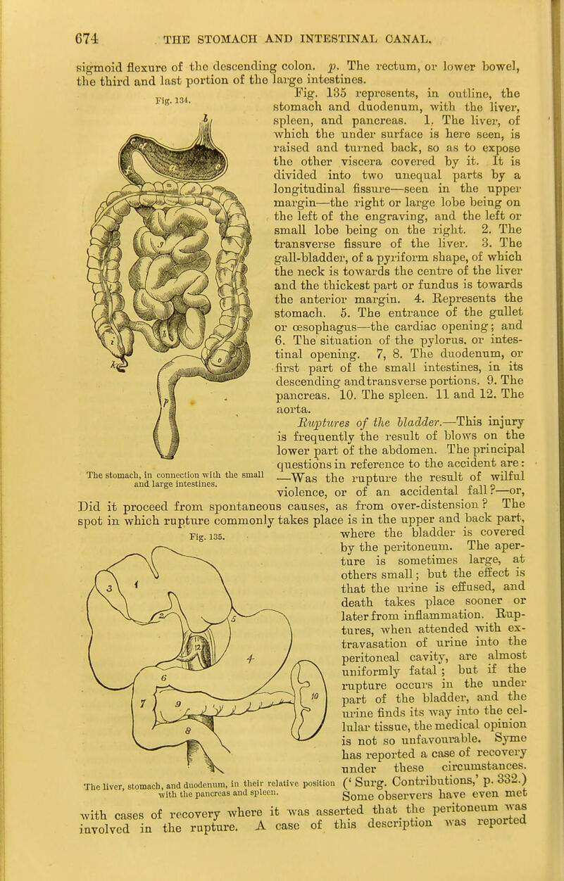 Fig. 134. sigmoid flexure of the descending colon, j?. The rectum, or lower bowel, the third and last portion of the large intestines. Pig. 135 represents, in outline, the stomach and duodenum, with the liver, spleen, and pancreas. 1. The liver, of which the under surface is here seen, is raised and turned back, so as to expose the other viscera covei-ed by it. It is divided into two unequal parts by a longitudinal fissure—seen in the upper margin—the right or large lobe being on the left of the engraving, and the left or small lobe being on the right. 2. The transverse fissure of the liver. 3. The gall-bladder, of a pyriform shape, of which the neck is towards the centre of the liver and the thickest part or fundus is towards the anterior margin. 4. Represents the stomach. 5. The entrance of the gullet or oesophagus—the cardiac opening; and 6. The situation of the pylorus, or intes- tinal opening. 7, 8. The duodenum, or first part of the small intestines, in its descending and trans verse portions. 9. The pancreas. 10. The spleen. 11 and 12. The aorta. Bu]3tures of the Madder.—This injury is fx'equently the result of blows on the lower part of the abdomen. The principal questions in reference to the accident are: —Was the rupture the result of wilful violence, or of an accidental fall?—or, Did it proceed from spontaneous causes, as from over-distension ? The spot in which rupture commonly takes place is in the upper and back part, Pig_i35, where the bladder is covered by the peritoneum. The aper- ture is sometimes large, at others small; but the effect is that the urine is effused, and death takes place sooner or later from inflammation. Rup- tures, when attended with ex- travasation of urine into the peritoneal cavity, are almost uniformly fatal ; but if the inipture occurs in the under part of the bladder, and the urine finds its way into the cel- lular tissue, the medical opinion is not so unfavourable. Syme has reported a case of recovery under these circumstances. (' Surg. Contributions,' p. 332.) Some observers have even met of recovery where it was asserted that the peritoneum was A case of this description was reported The stomach, in connection with the small and large intestines. The liver, stomach, and duodenum, in tlieir relative position with tlie pancreas and spleen. with cases involved in the rupture.