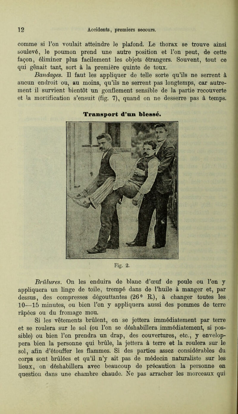 comme si l’on voulait atteindre le plafond. Le thorax se trouve ainsi soulevé, le poumon prend une autre position et l’on peut, de cette façon, éliminer plus facilement les objets étrangers. Souvent, tout ce qui gênait tant, sort à la première quinte de toux. Bandages. H faut les appliquer de telle sorte qu’üs ne serrent à aucun endroit ou, au moins, qu’üs ne serrent pas longtemps, car autre- ment il survient bientôt un gonflement sensible de la partie recouverte et la mortification s’ensuit (fig. 7), quand on ne desserre pas à temps. Transport d’on blessé. Fig. 2. Brûlures. On les enduira de blanc d’œuf de poule ou l’on y appbquera un linge de toile, trempé dans de rhuüe à manger et, par dessus, des compresses dégouttantes (26® R.), à changer toutes les 10—15 minutes, ou bien l’on y appliquera aussi des pommes de terre râpées ou du fromage mou. Si les vêtements brûlent, on se jettera immédiatement par terre et se roulera sur le sol (ou l’on se désbabülera immédiatement, si pos- sible) ou bien l’on prendra un drap, des couvertures, etc., y envelop- pera bien la personne qui brûle, la jettera à terre et la roulera sur le sol, afin d’étouffer les flammes. Si des parties assez considérables du corps sont brûlées et qu’ü n’y ait pas de médecin naturaliste sur les beux, on déshabillera avec beaucoup de précaution la personne en question dans une chambre chaude. Ne pas arracher les morceaux qui