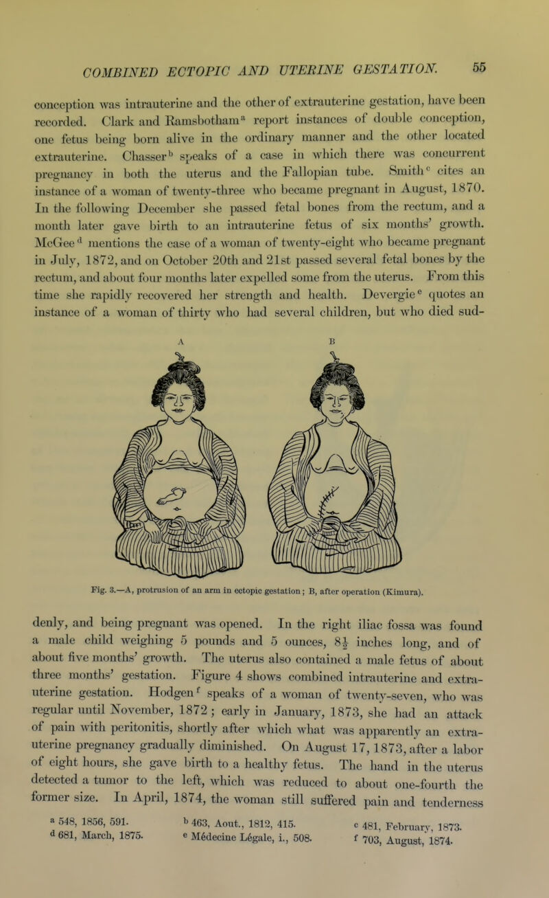 COMBINED ECTOPIC AND UTERINE GESTATION. conception was intrauterine and the other of extrauterine gestation, have been recorded. Clark and Ramsbothani'^ report instances of double conception, one fetus being born alive in the ordinary manner and the other located extrauterine. Chasser'^ speaks of a case in which there was concurrent pregnancy in both the uterus and the Fallopian tube. Smith cites an instance of a woman of twenty-three who became pregnant in August, 1870. In the following December she passed fetal bones from the rectum, and a month later gave birth to an intrauterine fetus of six months' growth. McGee mentions the case of a woman of twenty-eight who became pregnant in July, 1872, and on October 20th and 21st passed several fetal bones by the rectum, and about four months later expelled some from the uterus. From this time she rapidly recovered her strength and health. Devergie*' quotes an instance of a woman of thirty who had several children, but who died sud- Fig. 3.—A, protrusion of aa arm in ectopic gestation; B, after operation (Kimura). denly, and being pregnant was opened. In the right iliac fossa was found a male child weighing 5 pounds and 5 ounces, 8^ inches long, and of about five months' growth. The uterus also contained a male fetus of about three months' gestation. Figure 4 shows combined intrauterine and extra- uterine gestation. Hodgen speaks of a woman of twenty-seven, who was regular until November, 1872 ; early in January, 1873, she had an attack of pain with peritonitis, shortly after which what was apparently an extra- uterine pregnancy gradually diminished. On August 17,1873, after a labor of eight hours, she gave birth to a healthy fetus. The hand in the uterus detected a tumor to the left, which was reduced to about one-fourth the former size. In April, 1874, the woman still suffered pain and tenderness a 548, 3856, 591. d 681, March, 1875. b 463, Aout, 1812, 415. e M6decme L6gale, i., 508. c 481, February, 1873. f 703, August, 1874.