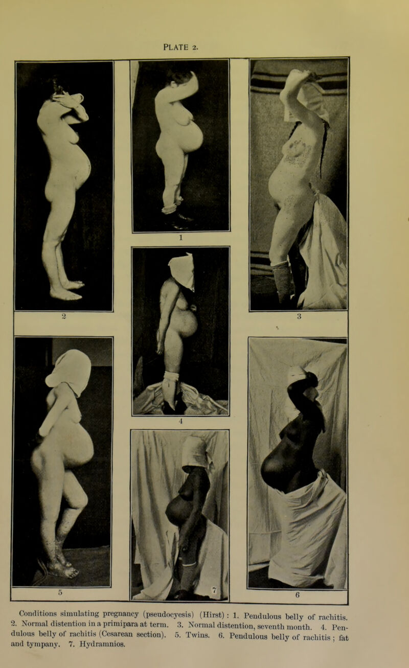 Conditions simulating pregnancy (pseudocyesis) (Hirst) : 1. Pendulous belly of rachitis. 2. Normal distention in a primipara at term. 3. Normal distention, seventh month. 4. Pen- dulous belly of rachitis (Cesarean section). 5. Twins. 6. Pendulous belly of rachitis • fat and tympany. 7. Hydramnios. '