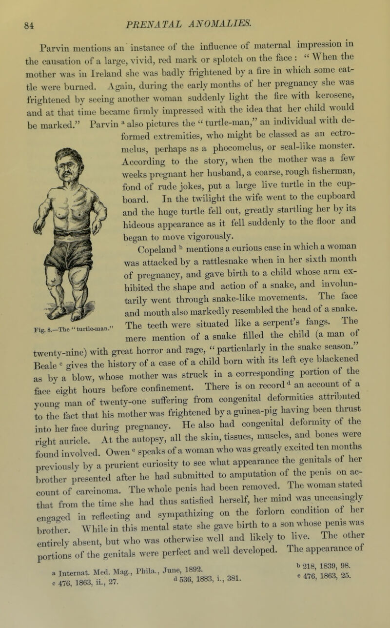 Parvin mentions an instance of the influence of maternal impression in the causation of a large, vivid, red mark or splotch on the face :  When the mother was in Ireland she was badly frightened by a fire in which some cat- tle were burned. Again, during the early months of her pregnancy she was frightened by seeing another woman suddenly light the fire with kerosene, and at that time became firmly impressed with the idea that her child would be marked. Parvin ^ also pictures the  turtle-man, an individual with de- formed extremities, who might be classed as an ectro- melus, perhaps as a phocomclus, or seal-like monster. According to the story, when the mother was a few weeks pregnant her husband, a coarse, rough fisherman, fond of rude jokes, put a large live turtle in the cup- board. In the twilight the wife went to the cupboard and the huge turtle fell out, greatly startling her by its hideous appearance as it fell suddenly to the floor and began to move vigorously. Copeland ^ mentions a curious case in which a woman was attacked by a rattlesnake when in her sixth month of pregnancy, and gave birth to a child whose arm ex- hibited the shape and action of a snake, and involun- tarily went through snake-like movements. The face and mouth also markedly resembled the head of a snake. The teeth were situated like a serpent's fangs. The mere mention of a snake filled the child (a man of twenty-nine) with great horror and rage,  particularly in the snake season. Beale'^ gives the history of a case of a child born with its left eye blackened as by a blow, whose mother was struck in a corresponding portion of the face eight hours before confinement. There is on record^ an account of a young man of twenty-one suff'ering from congenital deformities attributed to the fact that his mother was frightened by a guinea-pig having been thrust into her face during pregnancy. He also had congenital deformity of the right auricle. At the autopsy, all the skin, tissues, muscles, and bones were found involved. Owen ^ speaks of a woman who was greatly excited ten months previously by a prurient curiosity to see what appearance the genitals of her brother presented after he had submitted to amputation of the penis on ac- count of carcinoma. The whole penis had been removed. The woman stated that from the time she had thus satisfied herself, her mind was unceasingly engaged in reflecting and sympathizing on the forlorn condition of her brother While in this mental state she gave birth to a son whose penis was entirely absent, but who was otherwise well and likely to live. The other portions of the genitals were perfect and well developed. The appearance of Fig. 8.—The turtle-man. a Internat. Med. Mag., Phila., June, 1892. c 476, 1863, ii., 27. d 536, 1883, i., 381. b 218, 1839, 98. e 476, 1863, 25.