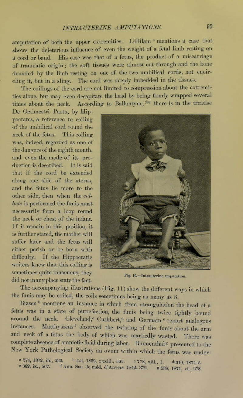 INTRAUTERINE AMPUTATIONS. amputation of both the upper extremities. Gillilani » mentions a case that shows the deleterious influence of even the weight of a fetal limb resting on a cord or band. His case was that of a fetus, the product of a miscarriage of traumatic origin; the soft tissues were almost cut through and the bone denuded by the limb resting on one of the two umbilical cords, not encir- cling it, but in a sling. The cord was deeply imbedded in the tissues. The coilings of the cord are not limited to compression about the extremi- ties alone, but may even decapitate the head by being firmly wrapped several times about the neck. According to Ballantyne,'^^^ there is in the treatise De Octimestri Partu, by Hip- pocrates, a reference to coiling of the umbilical cord round the neck of the fetus. This coiling was, indeed, regarded as one of the dangers of the eighth month, and even the mode of its pro- duction is described. It is said that if the cord be extended along one side of the uterus, and the fetus lie more to the other side, then when the eif/- bide is performed the funis must necessarily form a loop round the neck or chest of the infant. If it remain in this position, it is farther stated, the mother will sulfer later and the fetus will either perish or be born with difficulty. If the Hippocratic writers knew that this coiling is sometimes quite innocuous, they did not in any place state the fact. The accompanying illustrations (Fig. 11) show the different ways in which the funis may be coiled, the coils sometimes being as many as 8. Bizzen ^ mentions an instance in which from strangulation the head of a fetus was in a state of putrefaction, the funis being twice tightly bound around the neck. Cleveland,^ Cuthbert,'^ and Germain ^ report analogous instances. Matthyssens ^ observed the twisting of the funis about the arm and neck of a fetus the body of M'hich was markedly wasted. There was complete absence of amniotic fluid during labor. Blumenthal s presented to the New York Pathological Society an ovum within which the fetus was under- a 274, 1872, iii., 230. b 124^ 1352, xxxiii., 565. c 773, xiii., 1. d 610, 1874-5. e 362, ix., 567. f Ann. Soc. de m6d. d'Auvers, 1842, 372. g 538, 1871, vi., 278! Fig. 10.—Intrauterine amputation.