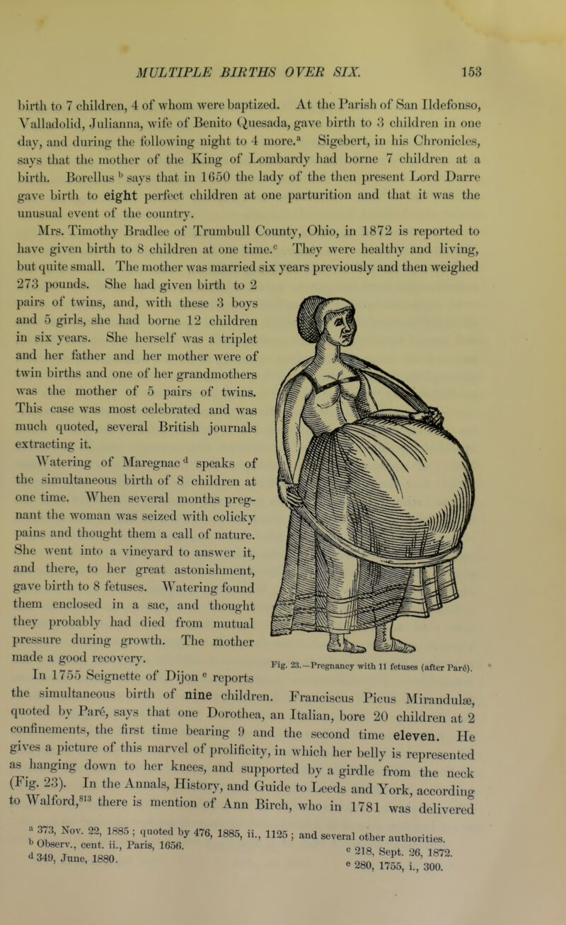 l)irth to 7 children, 4 of whom were baptized. At the Parish of San Ildefonso, y alkidolid, Julianna, wife of Benito Quesada, gave birth to 3 children in one day, and during the following night to 4 more/ Sigebcrt, in his Chronicles, says that the mother of the King of Lombardy had borne 7 children at a birth. Borelhis ^ says that in 1650 the lady of the then present Lord Darre gave birth to eight perfect children at one parturition and that it was the unusual event of the country. Mrs. Timotliy Bradlee of Trumbull County, Ohio, in 1872 is reported to have given birth to 8 children at one time.'' They were healthy and living, but quite small. The mother was married six years previously and then weighed 273 pounds. She had given birth to 2 pairs of twins, and, these 3 boys and 5 girls, she had borne 12 children in six years. She herself was a triplet and her father and her mother were of twin births and one of her grandmothers was the mother of 5 pairs of twins. This case was most celebrated and was much quoted, several British journals extracting it. Watering of Maregnac'^ speaks of the simultaneous birth of 8 children at one time. When several months preg- nant the woman was seized with colicky pains and thought them a call of nature. She went into a vineyard to answer it, and there, to her great astonishment, gave birth to 8 fetuses. Watering found them enclosed in a sac, and thought they probably had died from nuitual pressure during growth. The mother made a good recovery. In 1755 Seignette of Dijon ^ reports the simultaneous birth of nine children. Franciscus Picus Mirandulse, quoted by Par6, says that one Dorothea, an Italian, bore 20 children at 2 confinements, the first time bearing 9 and the second time eleven. He gives a picture of this marvel of prolificity, in which her belly is represented as hangmg down to her knees, and supported by a girdle from the neck (Fig. 23). In the Annals, History, and Guide to Leeds and York, according to Walford,«i=' there is mention of Ann Birch, who in 1781 was delivered a 373, Nov. 22 1885 ; quoted by 476, 1885, ii., 1125 ; and several other authorities, b Observ., cent, n., Pans, 165fi. e 218 Sent 96 1872 e28o;i755;r.!'3oo Fig. 23.—Pregnancy with 11 fetuses (after Par6).