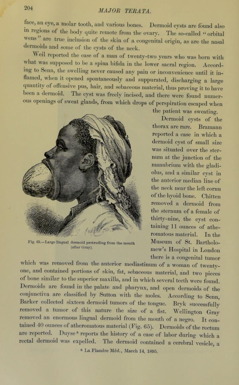 MAJOR TERATA. face, an eye, a molar tooth, and various bones. Dermoid cysts are found also in regions of the body quite remote from the ovary. The so-called  orbital wens^ are true inclusion of the skin of a congenital origin, as are the nasal dermoids and some of the cysts of the neck. ed reported the case of a man of twenty-two years who was born with what was supposed to be a spina bifida in the lower sacral region. Accord- lug to Senn, the swelling never caused any pain or inconvenience until it in- flamed, when it opened spontaneously and suppurated, discharging a large quantity of offensive pus, hair, and sebaceous material, thus proving it to have been a dermoid. The cyst was freely incised, and there were found numer- ous openings of sweat glands, from which drops of perspiration escaped when the patient was sweating. Dermoid cysts of the thorax are rare. Bramann reported a case in which a dermoid cyst of small size was situated over the ster- num at the junction of the manubrium with the gladi- olus, and a similar cyst in the anterior median line of the neck near the left cornu of the hyoid bone. Chitten removed a dermoid from the sternum of a female of thirty-nine, the cyst con- taining 11 ounces of athe- romatous material. In the Museum of St. Bartholo- mew's Hospital in London there is a congenital tumor which was removed from the anterior mediastinum of a woman of twenty- one, and contained portions of skin, fat, sebaceous material, and two pieces of bone similar to the superior maxilla, and in which several teeth were found. Dermoids are found in the palate and pharynx, and open dermoids of the conjunctiva are classified by Sutton with the moles. According to Senn, Barker collected sixteen dermoid tumors of the tongue. Bryk successfully removed a tumor of this nature the size of a fist. Wellington Gray removed an enormous lingual dermoid from the mouth of a negro. It con- ta,ined 40 ounces of atheromatous material (Fig. 65). Dermoids of the rectum are reported. Duysereports the history of a case of labor during which a rectal dermoid was expelled. The dermoid contained a cerebral vesicle, a a La Flandre M6d., March 14, 1895. Fig. 65.—Large lingual dermoid protruding from the mouth (after Gray).