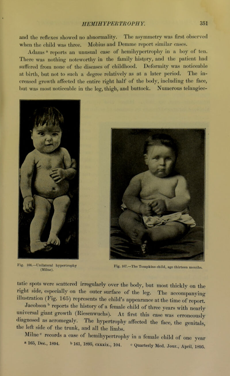 and the reflexes showed no abnormality. The asymmetry was first observed wlien the child was three. Mobius and Demme report similar cases. Adams * reports an unusual case of hemihypertrophy in a boy of ten. There was nothing noteworthy in the family histpry, and the patient had suffered from none of the diseases of childhood. Deformity was noticeable at birth, but not to such a degree relatively as at a later period. The in- creased growth affected the entire right half of the body, including the face, but was most noticeable in the leg, thigh, and buttock. Numerous telangiec- lilateral hypertrophy Fig. 167.-The Tompkins child, age thirteen months. (Milne). tatic spots were scattered irregularly over the body, but most thickly on the right side, especially on the outer surface of the leg. The accompanying illustration (Fig. 165) represents the child's appearance at the time of report Jacobson ^ reports the history of a female child of three years with nearly universal giant growth (Riesenwuchs). At first this case was erroneously diagnosed as acromegaly. The hypertrophy affected the fiice, the genitals, the left side of the trunk, and all the limbs. Milne records a case of hemihypertrophy in a female child of one year a 165, Dec, 1894. b lei, 1895, cxxxix., 104. c Quarterly Med. Jour., April, 1895.