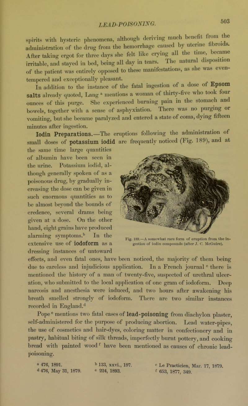 LEAD-POISONING. spirits with hysteric phenomena, although deriving much benefit from the administration of the drug from the hemorrhage caused by ut^^rmc fibroids. After taking ergot for three days she felt like crying all the time, became irritable, and stayed in bed, being all day in tears. The natural disposition of the patient was entirely opposed to these manifestations, as she was even- tempered and exceptionally pleasant. In addition to the instance of the fatal ingestion of a dose of Epsom salts already quoted, Lang ^ mentions a woman of thirty-five who took four ounces of this purge. She experienced burning pain in the stomach and bowels, together with a sense of asphyxiation. There was no purging or vomiting, but she became paralyzed and entered a state of coma, dying fifteen minutes after ingestion. lodin Preparations.—The eruptions following the administration of small doses of potassium iodid are frequently noticed (Fig. 189), and at the same time large quantities of albumin liave been seen in the urine. Potassium iodid, al- though generally spoken of as a poisonous drug, by gradually in- creasing the dose can be given in such enormous quantities as to be almost beyond the bounds of credence, several drams being given at a dose. On the other hand, eight grains have produced alarming symptoms.^ In the extensive use of iodoform as a dressing instances of untoward effects, and even fatal ones, have been noticed, the majority of them being due to careless and injudicious application. In a French journal there is mentioned the history of a man of twenty-five, suspected of urethral ulcer- ation, who submitted to the local application of one gram of iodoform. Deep narcosis and anesthesia were induced, and two hours after awakening his breath smelled strongly of iodoform. There are two similar instances recorded in England.'' Pope® mentions two fatal cases of lead-poisoning from diachylon plaster, self-administered for the purpose of producing abortion. Lead water-pipes, the use of cosmetics and hair-dyes, coloring matter in confectionery and in pastry, habitual biting of silk threads, imperfectly burnt pottery, and cooking bread with painted wood ^ have been mentioned as causes of chronic lead- poisoning. Fig. 189.—A somewhat rare form of eruption from the in- gestion of iodin compounds (after J. C. McGuire). a 476, 1891. 476, May 31, 1879. l> 133, xxvi., 197. e 224, 1893. c Le Practicien, Mar. 17, 1879. f 653, 1877, 349.