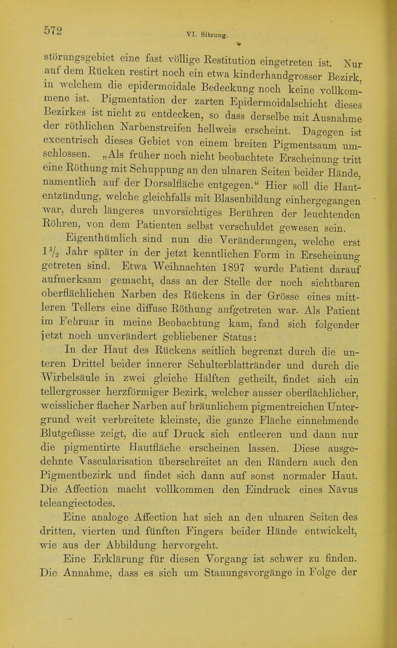 störungsgebiet eine fast völlige Restitution eingetreten ist. Nur auf dem Rücken restirt noch ein etwa kinderhandgrosser Bezirk m welchem die epidermoidale Bedeckung noch keine vollkom- mene ist. Pigmentation der zarten Epidermoidalschicht dieses Bezirkes ist nicht zu entdecken, so dass derselbe mit Ausnahme der röthhchen Narbenstreifen hellweis erscheint. Dagegen ist excentrisch dieses Gebiet von einem breiten Pigmentsaum um- schlossen. „Als früher noch nicht beobachtete Erscheinung tritt eine Röthung mit Schuppung an den ulnaren Seiten beider Hände, namentlich auf der Dorsalfläche entgegen. Hier soll die Haut- entzündung, welche gleichfalls mit Blasenbildung einhergegangen war, durch längeres unvorsichtiges Berühren der leuchtenden Röhren, von dem Patienten selbst verschuldet gewesen sein. Eigenthtimlich sind nun die Veränderungen, welche erst IV2 Jahr später in der jetzt kenntlichen Form in Erscheinung getreten sind. Etwa Weihnachten 1897 wurde Patient darauf aufmerksam gemacht, dass an der Stelle der noch sichtbaren oberflächlichen Narben des Rückens in der Grösse eines mitt- leren Tellers eine diffuse Röthung aufgetreten war. Als Patient im Februar in meine Beobachtung kam, fand sich folgender ietzt noch unverändert gebliebener Status: In der Haut des Rückens seitlich begrenzt durch die un- teren Drittel beider innerer Schulterblattränder und durch die Wirbelsäule in zwei gleiche Hälften getheilt, findet sich ein tellergrosser herzförmiger Bezirk, welcher ausser oberflächlicher, weisslicher flacher Narben auf bräunlichem pigmentreichen Unter- grund weit verbreitete kleinste, die ganze Fläche einnehmende Blutgefässe zeigt, die auf Druck sich entleeren und dann nur die pigmentirte Hautfläche erscheinen lassen. Diese ausge- dehnte Vascularisation überschreitet an den Rändern auch den Pigmentbezirk und findet sich dann auf sonst normaler Haut. Die Affection macht vollkommen den Eindruck eines Nävus teleangiectodes. Eine analoge Affection hat sich an den ulnaren Seiten des dritten, vierten und fünften Fingers beider Hände entwickelt, wie aus der Abbildung hervorgeht. Eine Erklärung für diesen Vorgang ist schwer zu finden. Die Annahme, dass es sich um Stauungsvorgänge in Folge der