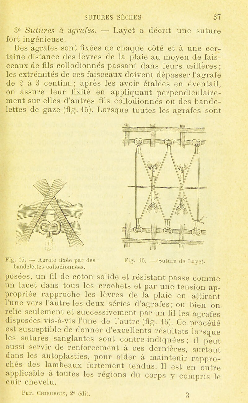 o Sutures à agrafes. — Laj-et a décrit une suture fort ingénieuse. Des agrafes sont fixées de chaque côté et à une cer- taine distance des lèvres de la plaie au moyen de fais- ceaux de fils collodionnés passant dans leurs œillères ; les extrémités de ces faisceaux doivent dépasser l'agrafe de 2 à 3 centim. ; après les avoir étalées en éventail, on assure leur fixité en appliquant perpendiculaire- ment sur elles d'autres fils collodionnés ou des bande- lettes de gaze (fig. 15). Lorsque toutes les agrafes sont g. 15. — Agrafe flséo pai- des bandelettes collodionnées. Fif^. 16. Suture de Lîivet. posées, un fil de coton solide et résistant passe comme un lacet dans tous les crochets et par une tension ap- propriée rapproche les lèvres de la plaie en attirant l'une vers l'autre les deux séries d'agrafes; ou bien on relie seulement et successivement par un fil les agrafes disposées vis-à-vis l'une de l'autre (fig. Ifi). Ce procédé est susceptible de donner d'excellents résultats lorsque les sutures sanglantes sont contre-indiquées ; il peut aussi servir de renforcement à ces dernières, surtout dans les autoplasties, pour aider à maintenir rappro- chés des lambeaux fortement tendus. Il est en outre applicable à toutes les régions du corps y compris le cuir chevelu. Pet. CiimuHGiE, 2'' édit. 3