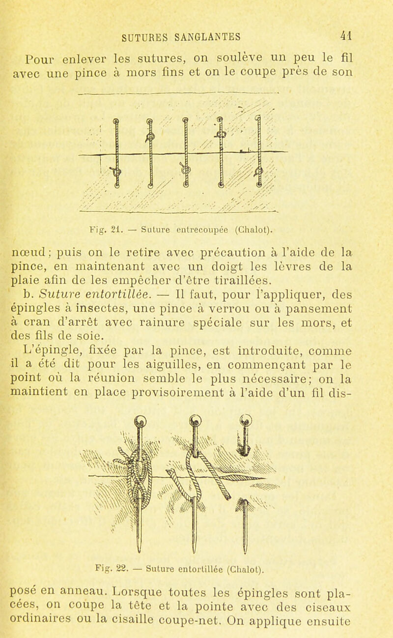 Pour enlever les sutures, on soulève un peu le fil avec une pince à mors fins et on le coupe près de son Fig. 21. —■ Siilure entrecoupée (Chalot). nœud ; puis on le retire avec précaution à l'aide de la pince, en maintenant avec un doigt les lèvres de la plaie afin de les empêcher d'être tiraillées. b. Suture entortillée. — Il faut, pour l'appliquer, des épingles à insectes, une pince à verrou ou à pansement à cran d'arrêt avec rainure spéciale sur les mors, et des fils de soie. L'épingle, fixée par la pince, est introduite, comme il a été dit pour les aiguilles, en commençant par le point où la réunion semble le plus nécessaire; on la maintient en place provisoirement à l'aide d'un fil dis- Fifr. 22. — Suture enlorlillée (Chalot). posé en anneau. Lorsque toutes les épingles sont pla- cées, on coupe la tête et la pointe avec des ciseaux ordinaires ou la cisaille coupe-net. On applique ensuite
