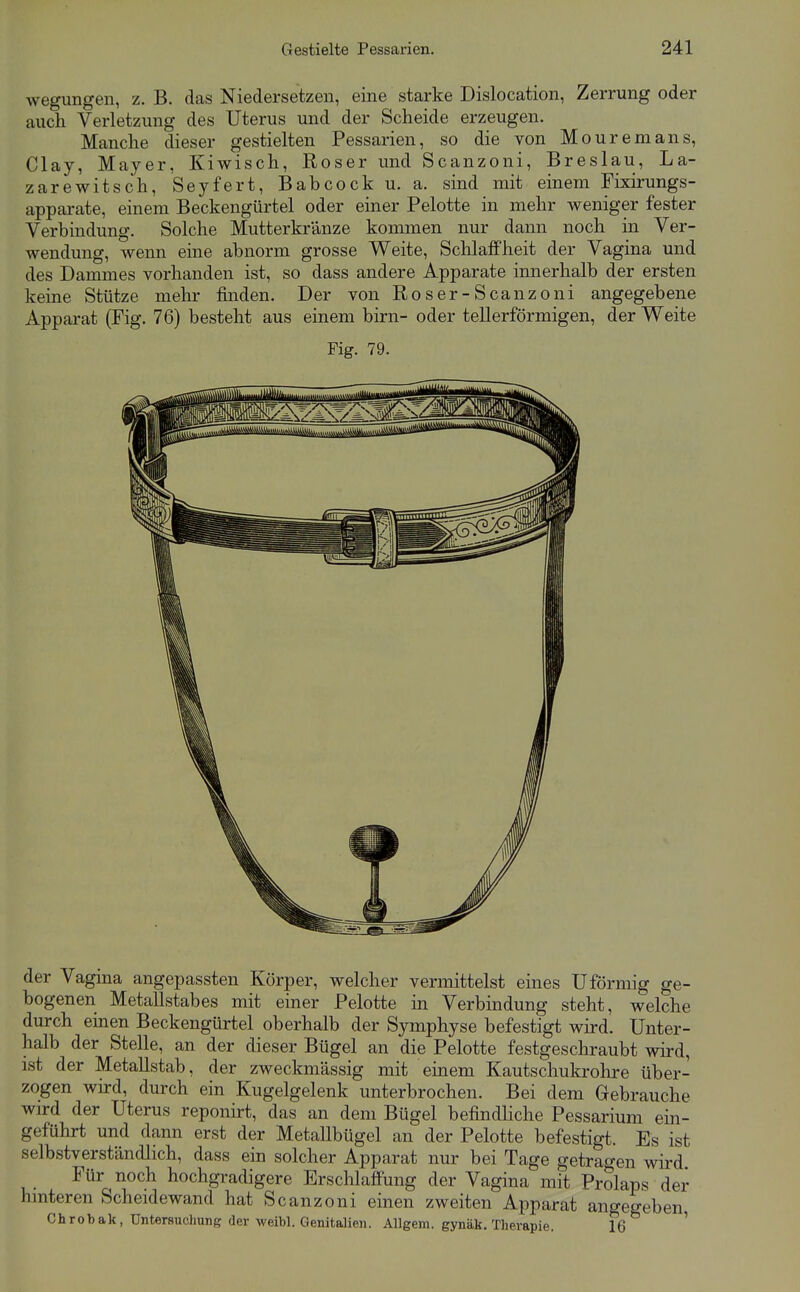 wegimgen, z. B. das Niedersetzen, eine starke Dislocation, Zerrung oder auch Verletzung des Uterus und der Scheide erzeugen. Manche dieser gestielten Pessarien, so die von Mouremans, Clay, Mayer, Kiwisch, Roser und Scanzoni, Breslau, La- zarewitsch, Seyfert, Babcock u. a. sind mit einem Fixirungs- apparate, einem Beckengürtel oder einer Pelotte in mehr weniger fester Verbindung. Solche Mutterkränze kommen nur dann noch in Ver- wendung, wenn eine abnorm grosse Weite, Schlaffheit der Vagina und des Dammes vorhanden ist, so dass andere Apparate innerhalb der ersten keine Stütze melir finden. Der von Roser-Scanzoni angegebene Apparat (Fig. 76) besteht aus einem bim- oder tellerförmigen, der Weite Fig. 79. der Vagina angepassten Körper, welcher vermittelst eines Uförmig ge- bogenen Metallstabes mit einer Pelotte in Verbindung steht, welche durch einen Beckengürtel oberhalb der Symphyse befestigt wird. Unter- halb der Stelle, an der dieser Bügel an die Pelotte festgeschraubt wird, ist der Metallstab, der zweckmässig mit einem Kautschukrohre über- zogen wird, durch ein Kugelgelenk unterbrochen. Bei dem Gebrauche wird der Uterus reponirt, das an dem Bügel befindliche Pessarium ein- geführt und dann erst der MetaUbügel an der Pelotte befestigt. Es ist selbstverständlich, dass ein solcher Apparat nur bei Tage getragen wird Für noch hochgradigere Erschlafi'ung der Vagina mit Prolaps der limteren Scheidewand hat Scanzoni einen zweiten Apparat angegeben Chrobak, Untersuchung der weibl. Genitalien. Allgem. gynäk. Therapie. IQ '