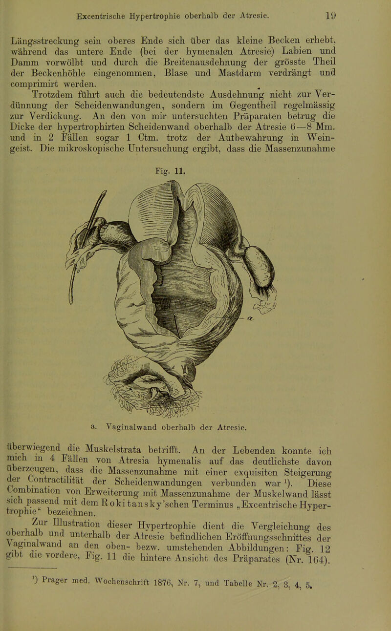 Längsstreckung sein oberes Ende sich über das kleine Becken erhebt, während das untere Ende (bei der hymenalen Atresie) Labien und Damm vorwölbt und durch die Breitenausdehnung der grösste Theil der Beckenhöhle eingenommen, Blase und Mastdarm verdrängt und comprimirt werden. Trotzdem fülirt auch die bedeutendste Ausdehnung nicht zur Ver- dünnung der Scheidenwandungen, sondern im Gegen theil regelmässig zur Verdickung. An den von mir untersuchten Präparaten betrug die Dicke der hypertrophirten Scheidenwand oberhalb der Atresie 6—8 Mm. und in 2 Fällen sogar 1 Ctm. trotz der Aulbewahrung in Wein- geist. Die mikroskopische Untersuchung ergibt, dass die Massenzunahnie Fig. 11. a. Vaginalwand oberhalb der Atresie. Überwiegend die Muskelstrata betrifft. An der Lebenden konnte ich mich m 4 Fällen von Atresia hymenalis auf das deutlichste davon uberzeugen, dass die Massenzunahme mit einer exquisiten Steigerung der Contractihtät der Scheidenwandungen verbunden war ^). Diese tombmation von Erweiterung mit Massenzunahme der Muskelwand lässt sich passend mit dem Roki tansky'schen Terminus „ExcentrischeHyper- trophie bezeichnen. v 1,^^^ Illustration dieser Hypertrophie dient die Vergleichung des oberhalb und unterhalb der Atresie befindlichen Eröffnungsschnittes der Vaginalwand an den oben- bezw. umstehenden Abbildungen: Fig 12 gibt die vordere, Fig. 11 die hintere Ansicht des Präparates (Nr. 164). 0 Prager med. Wochenschrift 1876, Nr. 7, und Tabelle Nr. 2, 3, 4, 5,