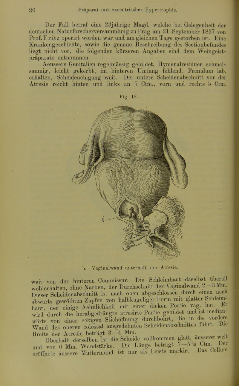 Der Fall betraf eine 23jälirige Magd, welche bei Gelegenheit der deutschen Naturfbrscherversammlung zu Prag am 21. September 1837 von Prof. Fritz operirt worden war und am gleichen Tage gestorben ist. Eine Krankengeschichte, sowie die genaue Beschreibung des Sectionbefundes liegt nicht vor, die folgenden kürzeren Angaben sind dem Weingeist- präparate entnommen. Aeussere Genitalien regelmässig gebildet, Hymenalresiduen schmal- saumig, leicht gekerbt, im hinteren Umfang fehlend, Frenulum lab. erhalten, Scheideneingang weit. Der untere Scheidenabschnitt vor der Atresie reicht liinten und links an 7 Ctm., vorn und rechts 5 Ctm. Fig. 12. b. Vaginalwand unterhalb der Atresie. weit von der hinteren Commissur. Die Schleimhaut daselbst iiberall wohlerhalten, ohne Narben, der Durchschnitt der Vaginalwand 2—3 Mm. Dieser Scheidenabschnitt ist nach oben abgeschlossen durch emen nach abwärts gewölbten Zapfen von halbkugeliger Form mit glatter Schleim- haut der einige Aehnlichkeit mit einer dicken Portio vag. hat. J^.r wird' durch die herabgedrängte atresirte Partie gebüdet und ist median- wärts von einer eckigen Stichöffnung durchbohrt die m die vordere Wand des oberen colossal ausgedehnten Scheidenabschnittes tulirt. Die Breite der Atresie beträgt 3—4 Mm. Oberhalb derselben ist die Scheide vollkommen glatt, äusserst weit und von 6 Mm. Wandstärke. Die Länge beträgt o-5 ^tm^ Der eröffnete äussere Muttermund ist nur als Leiste markirt. Das üoUuni