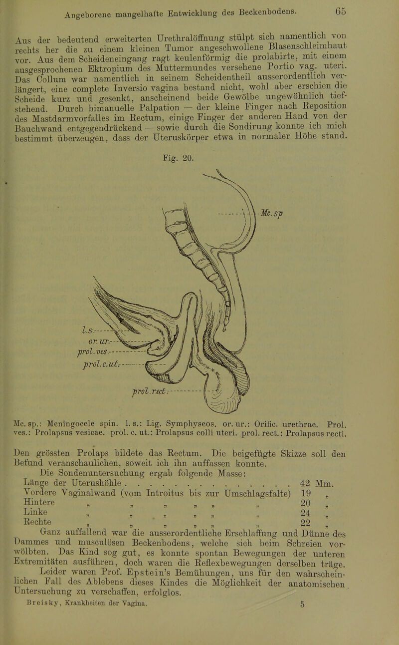 Angeborene mangelhafte Entwicklung des Beckenbodens. \us der bedeutend erweiterten ürethralöffnung stülpt sicli namentlich von rechts her die zu einem kleinen Tumor angeschwollene Blasenschleimhaut vor. Aus dem Scheideneingang ragt keulenförmig die prolabirte, mit einem ausf^esprochenen Ektropium des Muttermundes versehene Portio vag. uteri. Das Collum war namentlich in seinem Scheidentheil ausserordentlich ver- längert, eine complete Inversio vagina bestand nicht, wohl aber erschien die Scheide kurz und gesenkt, anscheinend beide Gewölbe ungewöhnlich tief- stehend. Durch bimanuelle Palpation — der kleine Finger nach Reposition des Mastdarmvorfalles im Rectum, einige Finger der anderen Hand von der Bauchwand entgegendrückend — sowie durch die Sondirung konnte ich mich bestimmt überzeugen, dass der üteruskörper etwa in normaler Höhe stand. Fig. 20. -Mc.s]) Mc. sp.: Meningocele spin. 1. s.: Lig. Symphyseos. or. ur.: Orific. urethrae. Prol. ves.: Prolapsus vesicae. prol. c. ut.: Prolapsus colli uteri, prol. rect.: Prolapsus recti. Den grössten Prolaps bildete das Rectum. Die beigefügte Skizze soll den Befund veranschaulichen, soweit ich ihn auffassen konnte. Die Sondenuntersuchung ergab folgende Masse: Länge der Uterushöhle 42 Mm. Vordere Vaginalwand (vom Introitus bis zur Umschlagsfalte) 19 „ Hintere « , „ , . 20 J^inke „ „ „ „ „ , 24 „ I^echte „ . „ „ „ 22 „ (jranz auffallend war die ausserordentliche Erschlaffung und Dünne des Dammes und musculösen Beckenbodens, welche sich beim Schreien vor- wölbten. Das Kind sog gut, es konnte spontan Bewegungen der unteren Extremitäten ausführen, doch waren die Reflexbewegungen derselben träge. Leider waren Prof. Epstein's Bemühungen, uns für den wahrschein- lichen Fall des Ablebens dieses Kindes die Möglichkeit der anatomischen Untersuchung zu verschaffen, erfolglos. Breisky, Krankheiten der Vagina. 5