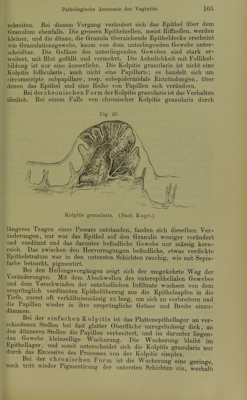 schreiten. Bei diesem Vorgang verändert sich das Epithel über dem Grannhmi ebenfalls. Die grossen Epithelzellen, meist Riffzellen, werden kleiner, und die dünne, die Granula überziehende Epitheldecke erscheint wie Granulationsgewebe, kaum von dem unterliegenden Gewebe unter- scheidbar. Die Gefässe des unterliegenden Gewebes sind stark er- weitert, mit Blut gefüllt und vermehrt. Die Aehnlichkeit mit FoUikel- bildung ist nur eine äusserliche. Die Kolpitis granularis ist nicht eine Kolpitis follicularis, auch nicht eine Papillaris; es handelt sich um circumscripte subpapillare, resp. subepidermidale Entzündungen, über denen das Epithel und eine Reihe von Papillen sich verändern. Bei der chronischen Form der Kolpitis granularis ist das Verhalten ähnlich. Bei einem Falle von chronischer Kolpitis granularis durch Fig. 28. Kolpitis granularis. (Nach Rüge.) längeres Tragen eines Pessars entstanden, fanden sich dieselben Ver- änderungen, nur war das Epithel auf den Granulis weniger verändert und verdünnt und das darunter befindliche Gewebe nur mässig kern- reich. Das zwischen den Hervorragungen befindliche, etwas verdickte Epithelstratum war in den untersten Schichten rauchig, wie mit Sepia- farbe betuscht, pigmentirt. Bei den Heilungsvorgängen zeigt sich der umgekehrte Weg der Veränderungen. Mit dem Abschwellen des unterepithelialen Gewebes und dem Verschwinden der entzündlichen Infiltrate wuchsen von dem ursprünglich verdünnten Epithelüberzug aus die Epithelzapfen in die Tiefe, zuerst oft verhältnissmässig zu lang, um sich zu verbreitern und die Papillen wieder in ihre ursprüngliche Grösse und Breite einzu- dämmen. Bei der einfachen Kolpitis ist das Plattenepithellager an ver- schiedenen Stellen bei fast glatter Oberfläche unregelmässig dick, an den dünneren Stellen die Papillen verbreitert, und im darunter liegen- den Gewebe kleinzellige Wucherung. Die Wucherung bleibt im Epithellager, und somit unterscheidet sich die Kolpitis granularis nur durch das Excessive des Processes von der Kolpitis simplex. Bei der chronischen Form ist die Wucherung eine o-eringe auch tritt wieder Pigmentirung der untersten Schichten ein, weshalb