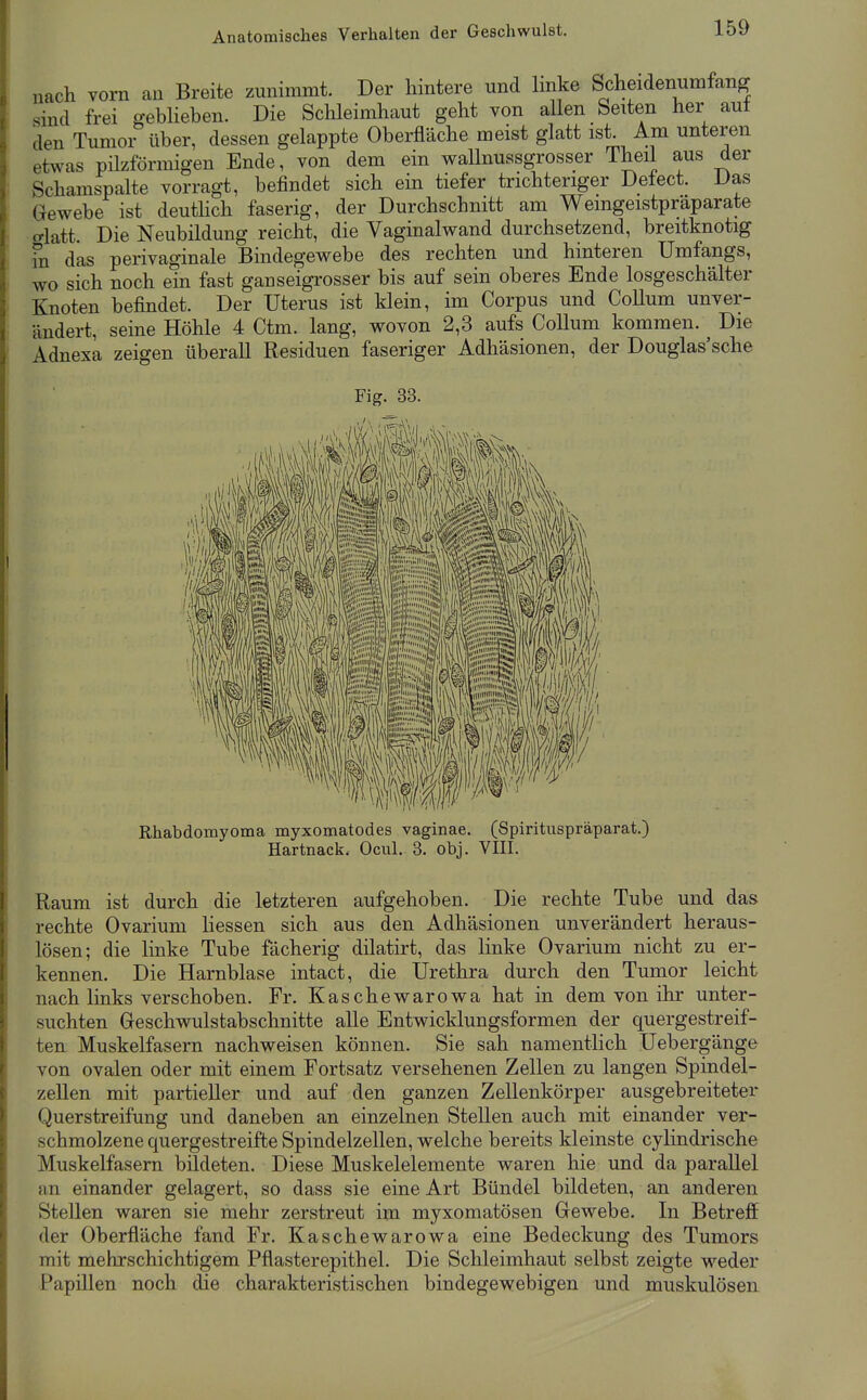 Anatomisches Verhalten der Geschwulst. nach vorn an Breite zunimmt. Der hintere und linke Scheidenumfan^ sind frei gebheben. Die Schleimhaut geht von allen Seiten her aut den Tumor über, dessen gelappte Oberfläche meist glatt ist. Am unteren etwas pilzförmigen Ende, von dem ein wallnussgrosser Theil aus der Schamspalte vorragt, befindet sich ein tiefer trichteriger Defect. Das Gewebe ist deuthch faserig, der Durchschnitt am Wemgeistpräparate (Tlatt. Die Neubildung reicht, die Vaginalwand durchsetzend, breitknotig m das perivaginale Bindegewebe des rechten und hinteren Umfangs, wo sich noch ein fast ganseigrosser bis auf sein oberes Ende losgeschälter Knoten befindet. Der Uterus ist klein, im Corpus und Collum unver- ändert, seine Höhle 4 Ctm. lang, wovon 2,3 aufs Collum kommen. Die Adnexa zeigen überall Residuen faseriger Adhäsionen, der Douglas'sche Fig. 33. Rhabdomyoma myxomatodes vaginae. (Spirituspräparat.) Hartnack. Ocul. 3. obj. VIII. Raum ist durch die letzteren aufgehoben. Die rechte Tube und das rechte Ovarium Hessen sich aus den Adhäsionen unverändert heraus- lösen; die linke Tube fächerig dilatirt, das linke Ovarium nicht zu er- kennen. Die Harnblase intact, die Urethra durch den Tumor leicht nach links verschoben. Fr. Kaschewarowa hat in dem von ihr unter- suchten Geschwulstabschnitte alle Entwicklungsformen der quergestreif- ten Muskelfasern nachweisen können. Sie sah namentlich üebergänge von ovalen oder mit einem Fortsatz versehenen Zellen zu langen Spindel- zellen mit partieller und auf den ganzen Zellenkörper ausgebreiteter Querstreifung und daneben an einzelnen Stellen auch mit einander ver- schmolzene quergestreifte Spindelzellen, welche bereits kleinste cylindrische Muskelfasern bildeten. Diese Muskelelemente waren hie und da parallel an einander gelagert, so dass sie eine Art Bündel bildeten, an anderen Stellen waren sie mehr zerstreut im myxomatösen Gewebe. In Betreff der Oberfläche fand Fr. Kaschewarowa eine Bedeckung des Tumors mit mehrschichtigem Pflasterepithel. Die Schleimhaut selbst zeigte weder Papillen noch die charakteristischen bindegewebigen und muskulösen