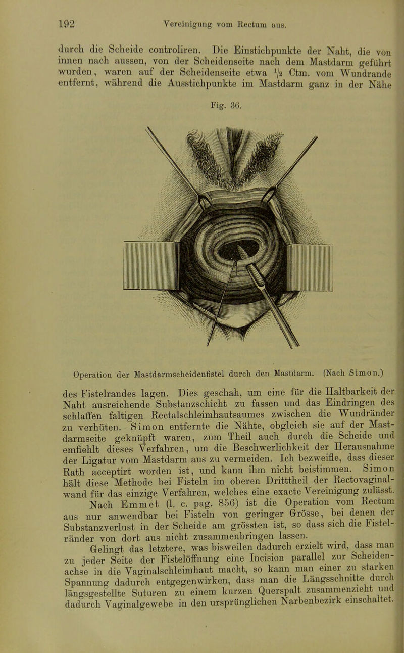 durch die Scheide controliren. Die Einstichpunkte der Naht, die von innen nach aussen, von der Scheidenseite nach dem Mastdarm geführt wurden, waren auf der Scheidenseite etwa 1/2 Ctm. vom Wundrande entfernt, während die Ausstichpunkte im Mastdarm ganz in der Nähe Fig. 36, Operation der Mastdarmscheidenfistel durch den Mastdarm, (Nach Simon,) des Fistelrandes lagen. Dies geschah, um eine für die Haltbarkeit der Naht ausreichende Substanzschicht zu fassen und das Eindringen des schlaffen faltigen ßectalschleimhautsaumes zwischen die Wundränder zu verhüten. Simon entfernte die Nähte, obgleich sie auf der Mast- darmseite geknüpft waren, zum Theil auch durch die Scheide und emfiehlt dieses Verfahren, um die Beschwerlichkeit der Herausnahme der Ligatur vom Mastdarm aus zu vermeiden. Ich bezweifle, dass dieser Rath acceptirt worden ist, und kann ihm nicht beistimmen. Simon hält diese Methode bei Fisteln im oberen Dritttheil der Rectovaginal- wand für das einzige Verfahren, welches eine exacte Vereinigung zulässt. Nach Emmet (1. c. pag. 856) ist die Operation vom Rectum aus nur anwendbar bei Fisteln von geringer Grösse, bei denen der Substanzverlust in der Scheide am grössten ist, so dass sich die Fistel- ränder von dort aus nicht zusammenbringen lassen. Gelingt das letztere, was bisweilen dadurch erzielt wird, dass man zu jeder Seite der Fistelöffnung eine Incision parallel zur Scheiden- achse in die Vaginalschleimhaut macht, so kann man einer zu starken Spannung dadurch entgegenwirken, dass man die Längsschmtte durch längsgestellte Suturen zu einem kurzen Querspalt zusammenzieht inid dadurch Vaginalgewebe in den ursprünglichen Narbenbezirk einschaltet.