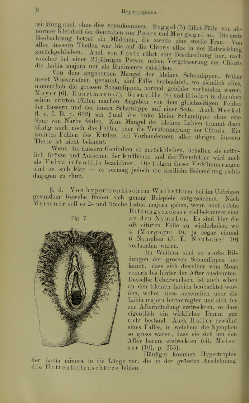 Hypertrophien. Wicklung auch ohne dies vorzukommen. Seggel (5) fülirt F^ÜIh von normer Kleinheit der ^ Becbachtung betraf eni Mädchen, die zweite einc^sterile ku {^.n allen äussern Theilen war bis auf die Clitoris alles in der Entwicklung zuruckgebheben. Auch von Coste rührt eine Beschreibung her, nach weldier bei emer 21 jährigen Person neben Vergrösserung der Clitoris die Labia majora nur als Rudimente existirten. Von dem angebornen Mangel der kleinen Schamlippen, früher meist Wasserlefzen genannt, sind Fälle beobachtet, wo ziemlich alles namentlich die grossen Schamlippen, normal gebildet vorhanden waren' Mayer (b) Haartmann (7), Granville (8) und Riolan in den oben schon citirten J^ällen machen Angaben von dem gleichzeitigen Fehlen der äussern und der innern Schamlippe auf einer Seite. Auch Meckel (I. c. L B p. 662) sah 2 mal die linke kleine Schamlippe ohne eine j^pur von Narbe fehlen. Zum Mangel der kleinen Labien kommt dann häufig auch noch das Fehlen oder die Verkümmerung der Clitoris Ein i^ohrtes Fehlen des Kitzlers bei Vorhandensein aller übrigen äus.-ern Theile ist nicht bekannt. Wenn die äussern GenitaHen so zurückbleiben, behalten sie natür- lich Grösse und Aussehen der kindlichen und der Formfehler wird auch als Vulva infantilis bezeichnet. Die Folgen dieser Verkümmerungen sind an sich klar — es vermag jedoch die ärzthche Behandlung r.ichts dagegen zu thun. §. 4. Von hypertrophischem Wachsthum bei im Uebrigen gesundem Gewebe finden sich genug Beispiele aufgezeichnet. Nach Meissner soll es 2- und 3fache Labia majora geben, wenn auch solche Bild ungsexcesse viel bekannter sind an den Nymphen. Es sind hier die oft citirten Fälle zu wiederholen, wo 4 (Morgagni 9), ja sogar einmal 6 Nymphen (J. E. Neubauer 10) vorhanden waren. Im Weitern sind so starke Bil- dungen der grossen Schamlippen be- kannt, dass sich dieselben vom Möns veneris bis hinter den After ausdehnten. Dasselbe Ueberwuchern ist auch schon an den kleinen Labien beobachtet wor- den, woher diese ansehnlich über die Labia majora hervorragten und sich bis zur Aftermündung erstreckten, so dass eigentlich ein wirklicher Damm gar nicht bestand. Auch Haller erwähnt eines Falles, in welchem die Nymphen so gross waren, dass sie sich um den After herum erstreckten (cit. Meiss- ner (10), p. 255). Häufiger kommen Hypertrophie der Labia minora in die Länge vor, die in der grössten Ausdehnung die Hottentottenschürze bilden. Fig. 7.