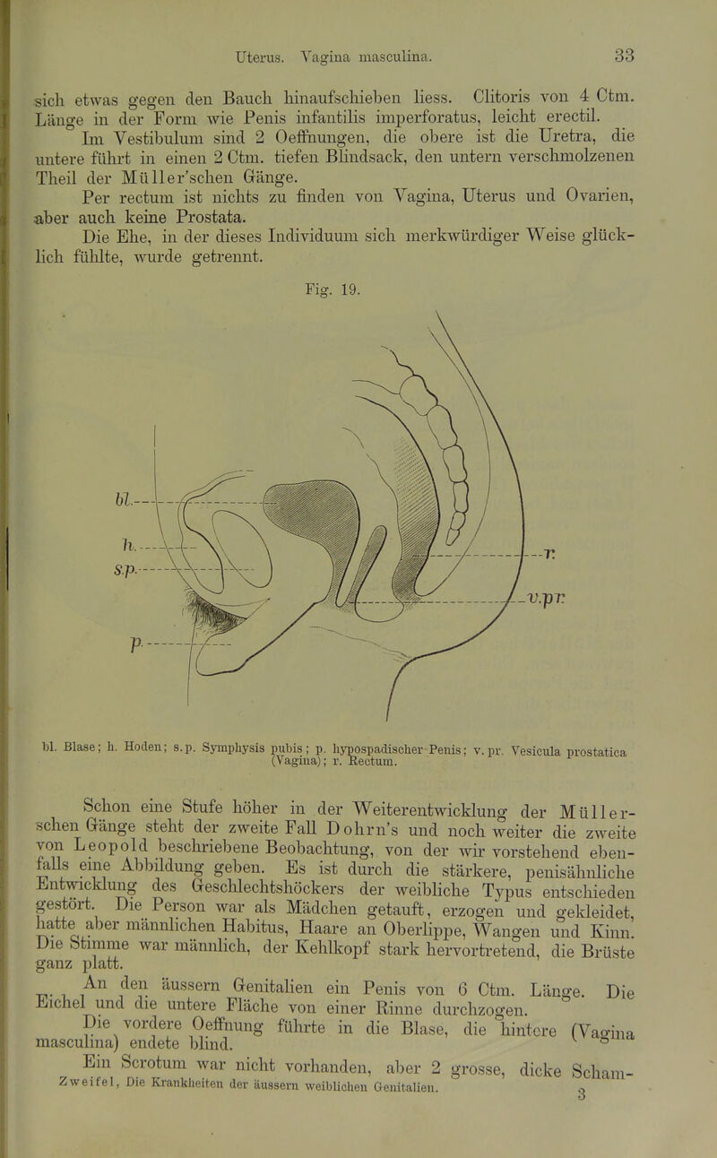 sich etwas gegen den Bauch hinaufschieben Hess. Clitoris von 4 Ctm. Länge in der Form wie Penis infantilis imperforatus, leicht erectil. Im Vestibulum sind 2 Oeffnungen, die obere ist die Uretra, die untere führt in einen 2 Ctm. tiefen Bhndsack, den untern verschmolzenen Theil der Müll ersehen Gränge. Per rectum ist nichts zu finden von Vagina, Uterus und Ovarien, aber auch keine Prostata. Die Ehe, in der dieses Individuum sich merkwürdiger Weise glück- lich fülilte, wurde getrennt. Fig. 19. bl. Blase; h. Hoden; s.p. Symphysis pubis; p. hypospadischer Penis; v.pr. Vesicula prostatica (Vagina); r. Rectum. Schon eme Stufe höher in der Weiterentwicklung der Müll er- sehen Gänge steht der zweite Fall Dohrn's und noch weiter die zweite von Leopold beschriebene Beobachtung, von der wir vorstehend eben- feUs eine Abbüdung geben. Es ist durch die stärkere, penisähnliche Entwicklung des Geschlechtshöckers der weibliche Typus entschieden gestört Die Person war als Mädchen getauft, erzogen und gekleidet, hatte aber männhchen Habitus, Haare an Oberlippe, Wangen und Kinn. Die btimme war männlich, der Kehlkopf stark hervortretend, die Brüste ganz platt. T?- -u GenitaUen ein Penis von 6 Ctm. Länge. Die Eichel und die untere Fläche von einer Rinne durchzoo-en. Die vordere Oeffnung führte in die Blase, die hintere fVao-ina masculina) endete blind. ° Ein Scrotum war nicht vorhanden, aber 2 grosse, dicke Scham- Zweifel, Die Krankheiten der äussern weiblichen Genitalien. o