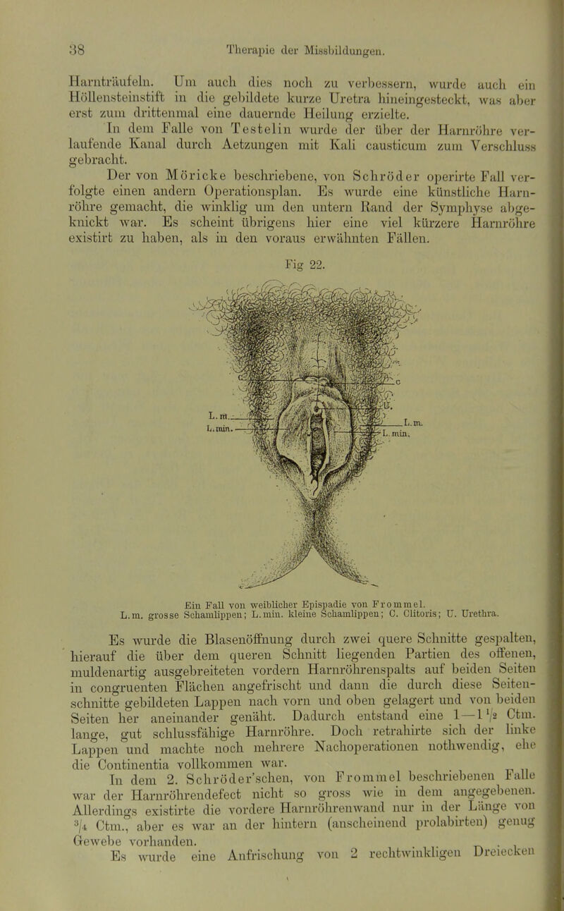 Harnträufeln. Um auch dies noch zu verljessern, wurde auch ein Höllensteinstift in die gebildete kurze Uretra hineingesteckt, was al)er erst zum drittenmal eine dauernde Heilung erzielte. In dem Falle von Testelin wurde der über der Harnröhre ver- laufende Kanal durch Aetzungen mit Kali causticum zum Verschluss gebracht. Der von Möricke beschriebene, von Schröder operirte Fall ver- folgte einen andern Operationsplan. Es wurde eine künstliche Harn- röhre gemacht, die winklig um den untern Rand der Symphyse abge- knickt war. Es scheint übrigens hier eine viel kürzere Harnröhre existirt zu haben, als in den voraus erwähnten Fällen. Fig 22. Ein Fall von weiblicher Epispadie von Frommel. L.m. grosse Schamlippen; L.min. kleine Schamlippen; C. Clitoris; U. Urethra. Es wurde die Blasenöffnung durch zwei quere Schnitte gespalten, hierauf die über dem queren Schnitt liegenden Partien des offenen, muldenartig ausgebreiteten vordem Harnröhrenspalts auf beiden Seiten in cono-ruenten Flächen angefrischt und dann die durch diese Seiten- schnitte gebildeten Lappen nach vorn und oben gelagert und von beiden Seiten her aneinander genäht. Dadurch entstand eine 1 — 1V2 Ctm. lange, gut schlussfähige Harnröhre. Doch retrahirte sich der linke Lappen °und machte noch mehrere Nachoperationen notliwendig, ehe die Continentia vollkommen war. Li dem 2. Schröder'schen, von Frommel beschriebenen Falle war der Harnröhrendefect nicht so gross wie in dem angegebenen. Allerdings existh'te die vordere Harnröhrenwand nur in der Länge von Ctm.° aber es war an der hintern (anscheinend prolabirten) genug Gewebe vorhanden. . Es wurde eine Anfrischung von 2 rechtwinkligen Dreiecken