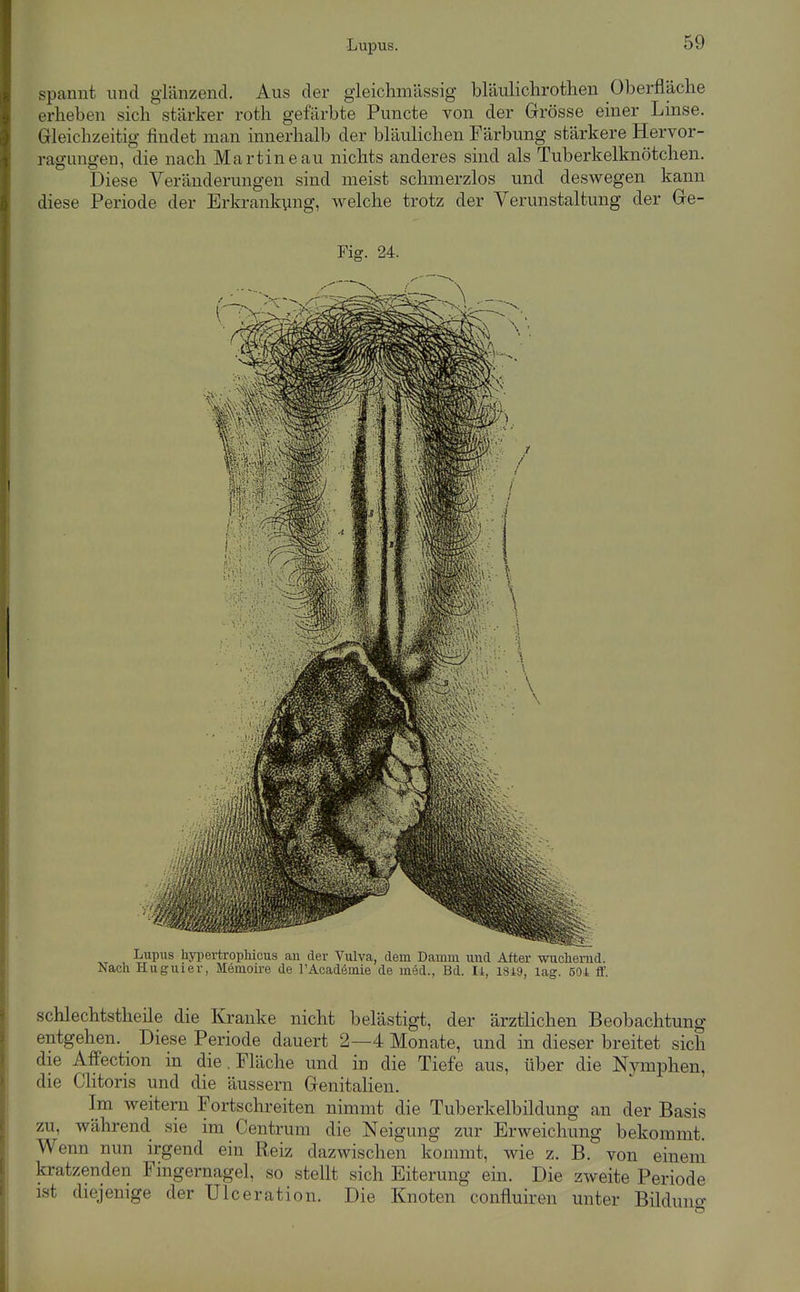 spannt und giänzencl. Aus der gleichmässig bläulichrothen Oberfläche erheben sich stärker roth gefärbte Pimcte von der Grösse einer Linse. Gleichzeitig findet man innerhalb der bläulichen Färbung stärkere Hervor- ragungen, die nach Martine au nichts anderes sind als Tuberkelknötchen. Diese Veränderungen sind meist schmerzlos und deswegen kann diese Periode der Erkrankung, welche trotz der Verunstaltung der Ge- Fig. 24. Lupus hypertrophicus an der Vulva, dem Damm und After wuchernd. Nach Huguier, Memoire de l'Academie de med., Bd. Ii, I8i9, lag. 50A flf. schlechtstheüe die Kranke nicht belästigt, der ärztlichen Beobachtung entgehen. Diese Periode dauert 2—4 Monate, und in dieser breitet sich die Affection in die. Fläche und in die Tiefe aus, über die Nymphen, die Clitoris und die äussern Genitalien. Im weitem Fortschreiten nimmt die Tuberkelbildung an der Basis zu, während sie im Centrum die Neigung zur Erweichung bekommt. Wenn nun irgend ein Reiz dazwischen kommt, wie z. B. von einem kratzenden Fingernagel, so stellt sich Eiterung ein. Die zweite Periode ist diejenige der Ulceration. Die Knoten confluiren unter Bilduno-