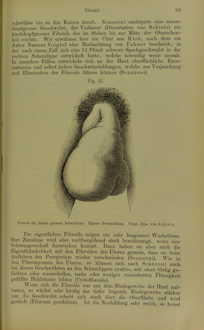 schwülste bis zu den Knieen herab. Scanzoni exstirpirte eme mann- taustgrosse Geschwulst, der Verfasser (Dissertation von Schiele) ein kindskopfgrosses Fibroid, das im Stehen bis zur Mitte der Oberschen- kel reichte. Wir erwähnen hier ein Citat aus Klob, nach dem ein Autor Namens Voigtei eine Beobachtung von Fahner beschrieb, in der nach einem Fall sich eine 12 Pfund schwere Speckgeschwulst in der rechten Schamlippe entwickelt hatte, welche inwendig weiss aussah. In manchen Fällen entwickeln sich an der Haut oberflächliche Bxco- riationen und selbst tiefere Geschwürsbildungen, welche zur Verjauchung imd Elimination der Fibroide führen können (Scanzoni). Fig. 35. Fibroid der linken grossen Schamlippe. Eigene Beobachtung. Vergl. Diss. von Schiele. Die eigentlichen Fibroide zeigen ein sehr langsames Wachsthum. Ihre Zunahme wird aber vorübergehend stark beschleunigt, wenn eine Schwangerschaft dazwischen kommt. Dann haben sie aber auch die Eigenthümlichkeit mit den Fibroiden des Uterus gemein, dass sie beim Aufhören des Puerperium wieder verschwinden (Scanzoni). Wie in den Fibromyomen des Uterus, so können sich nach Scanzoni auch bei diesen Geschwülsten an den Schamlippen cystöse, mit einer blutig ge- erbten oder wasserhellen, mehr oder weniger consistenten Flüssigkeit gefüllte Hohlräume bilden (Cystofibroide). Wenn sich die Fibroide nur aus dem Bindegewebe der Haut auf- bauen, so wächst sehr häufig das tiefer liegende Bindegewebe stärker vor, die Geschwulst erhebt sich stark über die Oberfläche und wird gestielt (Fibroma pendulum). Ist die Neubildung sehr weich, so heisst