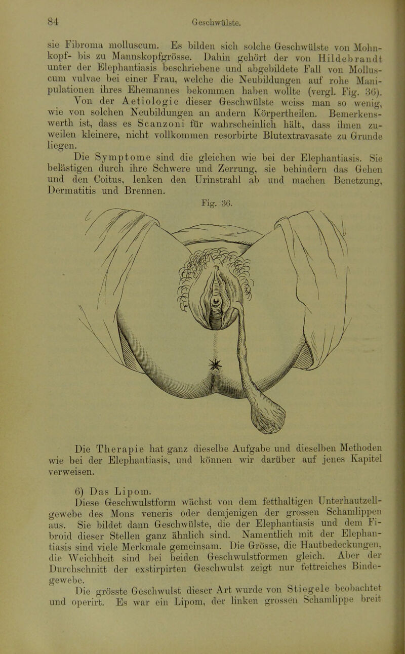 sie Fibronui mollusciim. Es bilden sich solche Greschwülste von M(j1ui- kopf- bis zu Mannskopfgrösse. Dahin gehört der von Hildebrandt unter der Elephantiasis beschriebene und abgeljildete Fall von Mollus- cum vulvae bei einer Frau, welche die Neubildungen auf rohe Mani- pulationen ihres Ehemannes bekommen haljen wollte (vergl. Fig. 30). Von der Aetiologie dieser Geschwülste weiss man so wenig, wie von solchen Neubildungen an andern Körpertheilen. Bemerkens- Averth ist, dass es Scanzoni für wahrscheinlich hält, dass ihnen zu- weilen kleinere, nicht vollkommen resorbirte Blutextravasate zu Grrunde liegen. Die Symptome sind die gleichen wie bei der Elephantiasis. Sie belästigen durch ihre Schwere und Zerrung, sie behindern das Gehen und den Coitus, lenken den Urinstrahl ab und machen Benetzung, Dermatitis und Brennen. Fig. 36. Die Therapie hat ganz dieselbe Aufgabe und dieselben Methoden wie bei der Elephantiasis, und können wir darüber auf jenes Kapitel verweisen. 6) Das Lipom. Diese Geschwulstform wächst von dem fetthaltigen Unterhautzell- gewebe des Möns veneris oder demjenigen der grossen Schamlippen aus. Sie bildet dann Geschwülste, die der Elepliantiasis und dem Fi- broid dieser Stellen ganz ähnlich sind. Namentlich mit der Elephan- tiasis sind viele Merkmale gemeinsam. Die Grösse, die Hautbedeckungen, die Weichheit sind bei beiden Geschwulstformen gleich. Aber der Durchschnitt der exstirpirten GeschAvulst zeigt nur fettreiches Binde- gewebe. Die grösste Geschwulst dieser Art wurde von Stiegele beobachtet und operirt. Es war ein Lipom, der linken grossen Schamlippe breit