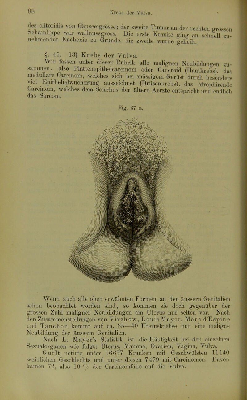 des chtoridis von Gänseeigrösse; der zweite Tumor an der rechten grossen Schanilippe Avar walhiussgross. Die erste Kranke ging an schnell zu- nehmender Kachexie zu Grunde, die zweite wurde geheilt. §. 45. 13) Krebs der Vulva. Wir fassen unter dieser Rubrik alle malignen Neubildungen zu- sammen, also Plattenepithelcarcinom oder Cancroid (Hautkrebs), das medulläre Carcinom, Avelches sich bei massigem Gerüst durch besonders viel Epithelialwucherung auszeichnet (Drüsenkrebs), das atrophirende Carcinom, welches dem Scirrhus der altern Aerzte entspricht und endlich das Sarcom. Fig. 37 a. Wenn auch alle oben erwähnten Formen an den äussern Genitalien schon beobachtet worden sind, so kommen sie doch gegenüber der grossen Zahl maligner Neubildungen am Uterus nur selten vor. Nach den Zusammenstellungen von Virchow, Louis Mayer, Marc d'Espiue und Tanchon kommt auf ca. 35—40 Uteruskrebse nur eine maligne Neubildung der äussern Genitalien. Nach L. Mayer's Statistik ist die Häufigkeit bei den einzehien Sexualorganen wie folgt: Uterus, Mamma, Ovarien, Vagina, Vulva. Gurlt notirte unter 16637 Kranken mit Geschwülsten 11140 weiblichen Geschlechts und unter diesen 7479 mit Carcinomen. Davon kamen 72, also 10 /o der Carcinomfälle auf die Vulva.