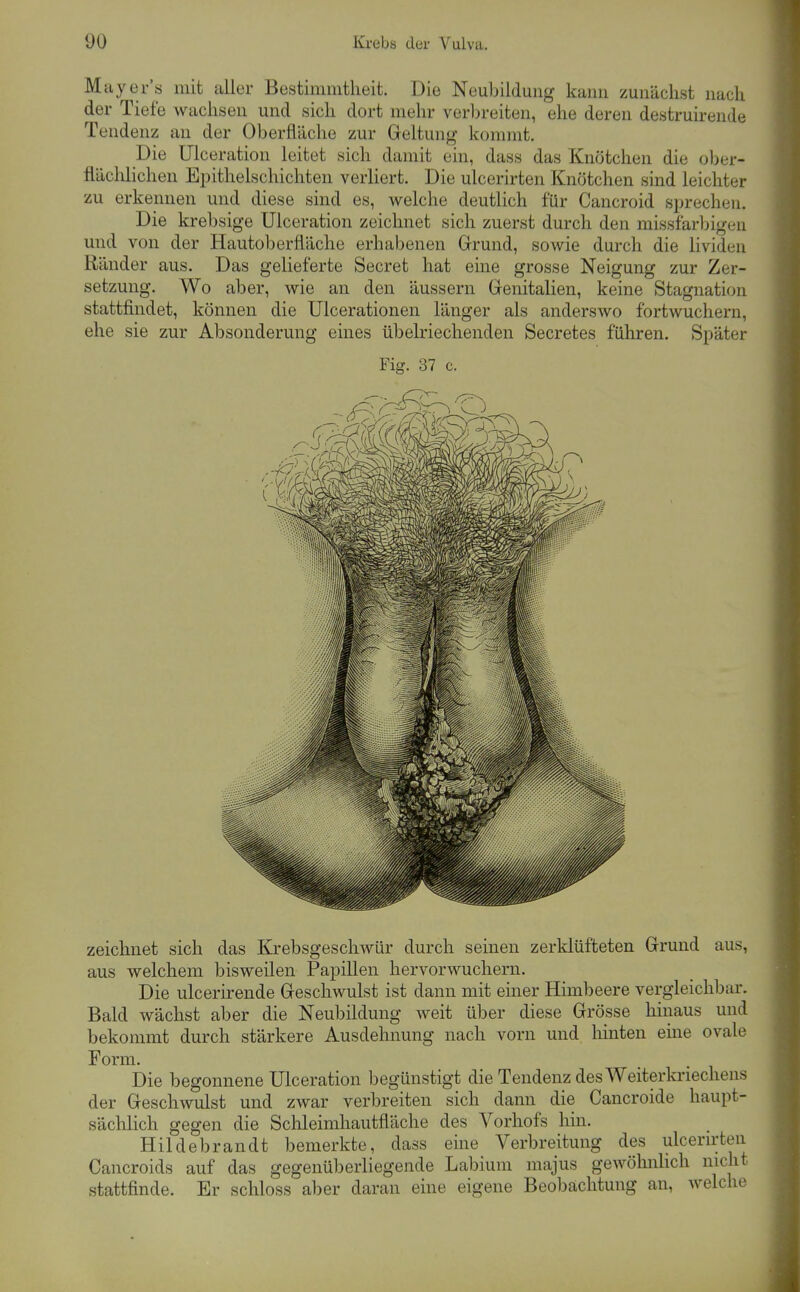 Miiyer's mit aller Bestiniiiitlieit. Die Neubildung kann zunächst nach der Tiefe Avachsen und sich dort mehr verlireiten, ehe deren destruirende Tendenz an der Oberfläche zur Geltung kommt. Die Ulceration leitet sich damit ein, dass das Knötchen die ober- flächlichen Epithelschichten verliert. Die ulcerirten Knötchen sind leichter zu erkennen und diese sind es, welche deutlich für Cancroid sprechen. Die krebsige Ulceration zeichnet sich zuerst durch den missfarbigen und von der Hautoberfläche erhabenen Grrund, soAvie durch die lividen Ränder aus. Das gelieferte Secret hat eine grosse Neigung zur Zer- setzung. Wo aber, wie an den äussern Grenitalien, keine Stagnation stattfindet, können die Ulcerationen länger als anderswo fortwuchern, ehe sie zur Absonderung eines übelriechenden Secretes führen. Später Fig. 37 c. zeichnet sich das Krebsgeschwür durch seinen zerklüfteten Grund aus, aus welchem bisweilen Papillen hervorwuchern. Die ulcerirende Geschwulst ist dann mit einer Himbeere vergleichbar. Bald wächst aber die Neubildung weit über diese Grösse hinaus und bekommt durch stärkere Ausdehnung nach vorn und hinten eine ovale Form. Die begonnene Ulceration begünstigt die Tendenz desWeiterkriecliens der Geschwulst und zwar verbreiten sich dann die Cancroide haupt- sächlich gegen die Schleimhautfläche des Vorhofs hin. Hildebrandt bemerkte, dass eine Verbreitung des ulcern;teu Cancroids auf das gegenüberliegende Labium majus gewöhnUch nicht stattfinde. Er schloss aber daran eine eigene Beobachtung an, welche