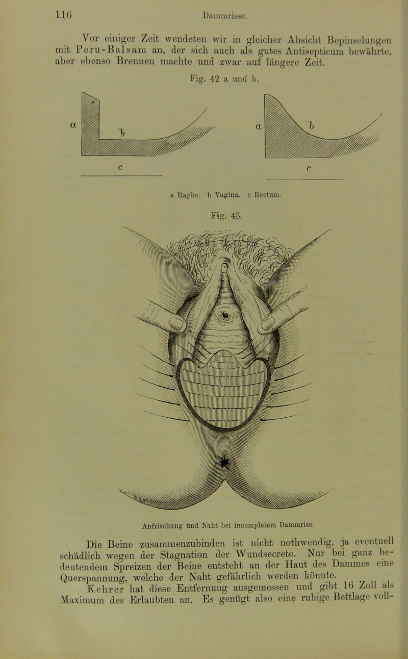 llü Dauuul-iäHe. Vor einiger Zeit wendeten wir in gleicher Al)sicht Bepinselungen mit Peru-Balsam an, der sich auch als gutes Antisepticum bewährte, aber ebenso Brennen machte und zwar auf längere Zeit. Fig. 42 a und b. a ßaphe. b Vagina, c Rectum. Fig. 43. Anfrischung und Naht hei incompletem Dammriss. Die Beine zusammenzubinden ist nicht nothwendig, ja eventuell schädlich wegen der Stagnation der Wundsecrete. Nur bei ganz be- deutendem Spreizen der Beine entsteht an der Haut des Dammes eme Querspannung, welche der Naht gefährlich werden könnte. Kehr er hat diese Entfernung ausgemessen und gibt 16 Zoll als Maximum des Erlaubten an. Es genügt also eine ruhige Bettlage voU-