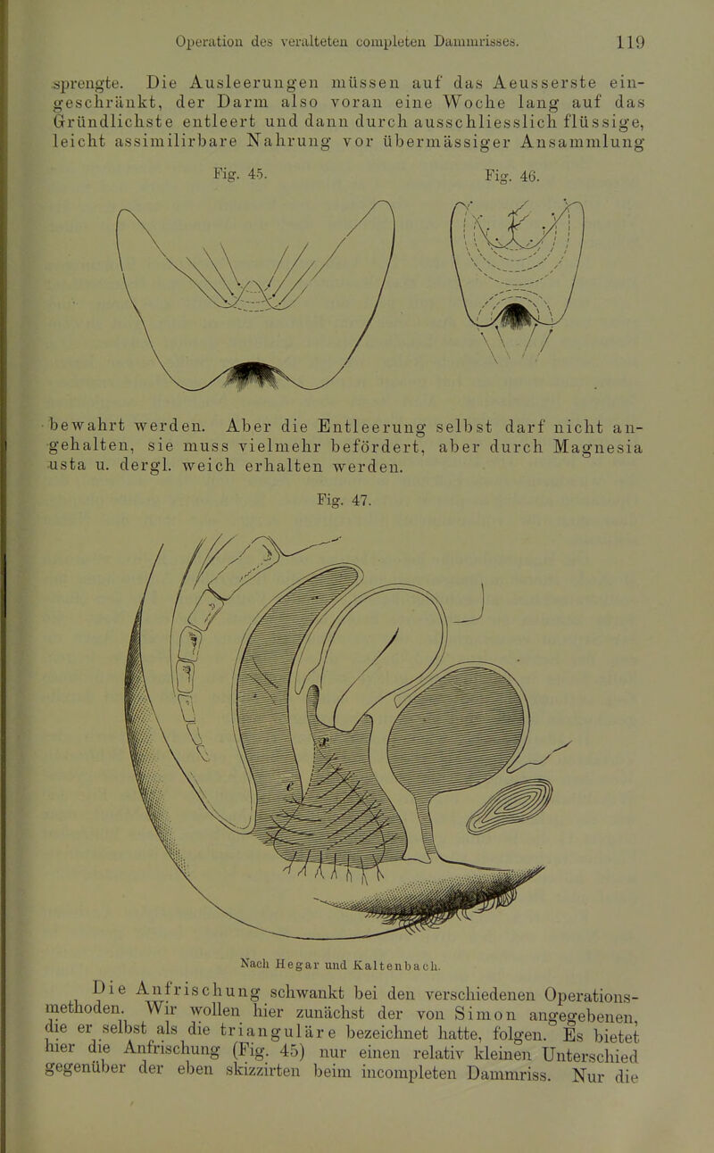 sprengte. Die Ausleerungen müssen auf das Aeusserste ein- geschränkt, der Darm also voran eine Woche lang auf das Gründlichste entleert und dann durch ausschliesslich flüssige, leicht assimilirbare Nahrung vor übermässiger Ansammlung Fig. 45. Fig. 46. bewahrt werden. Aber die Entleerung selbst darf nicht an- gehalten, sie muss vielmehr befördert, aber durch Magnesia usta u. dergl. weich erhalten werden. Fig. 47. Nach Hegar und Kaltenbach. Die Anfrischung schwankt bei den verschiedenen Operations- methoden Wir wollen hier zunächst der von Simon angegebenen die er selbst als die trianguläre bezeichnet hatte, folgen. Es bietet hier die Anfrischung (Fig. 45) nur einen relativ kleben Unterschied gegenüber der eben skizzirten beim incompleten Dammriss. Nur die
