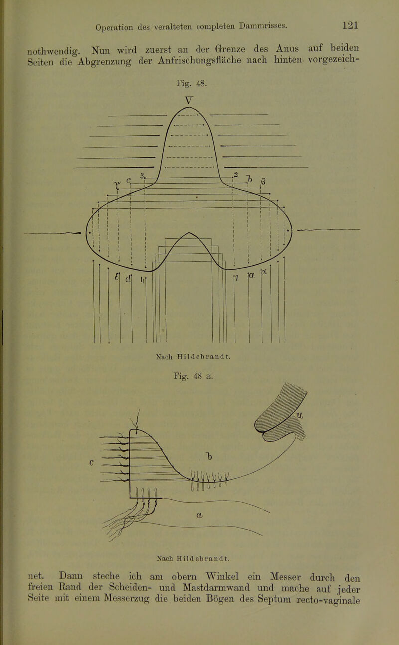 notliAveiKlig. Nun wird zuerst an der Grenze des Anus auf beiden Seiten die Abgrenzung der Anfrischungsfläche nach hinten vorgezeich- Fig. 48. V Nach Hildebrandt. Fig. 48 a. Nach Hildebrandt. net. Dann steche ich am obern Winkel ein Messer durch den freien Rand der Scheiden- und Mastdarmwand und mache auf jeder Seite mit einem Messerzug die beiden Bögen des Septum recto-vao-inale