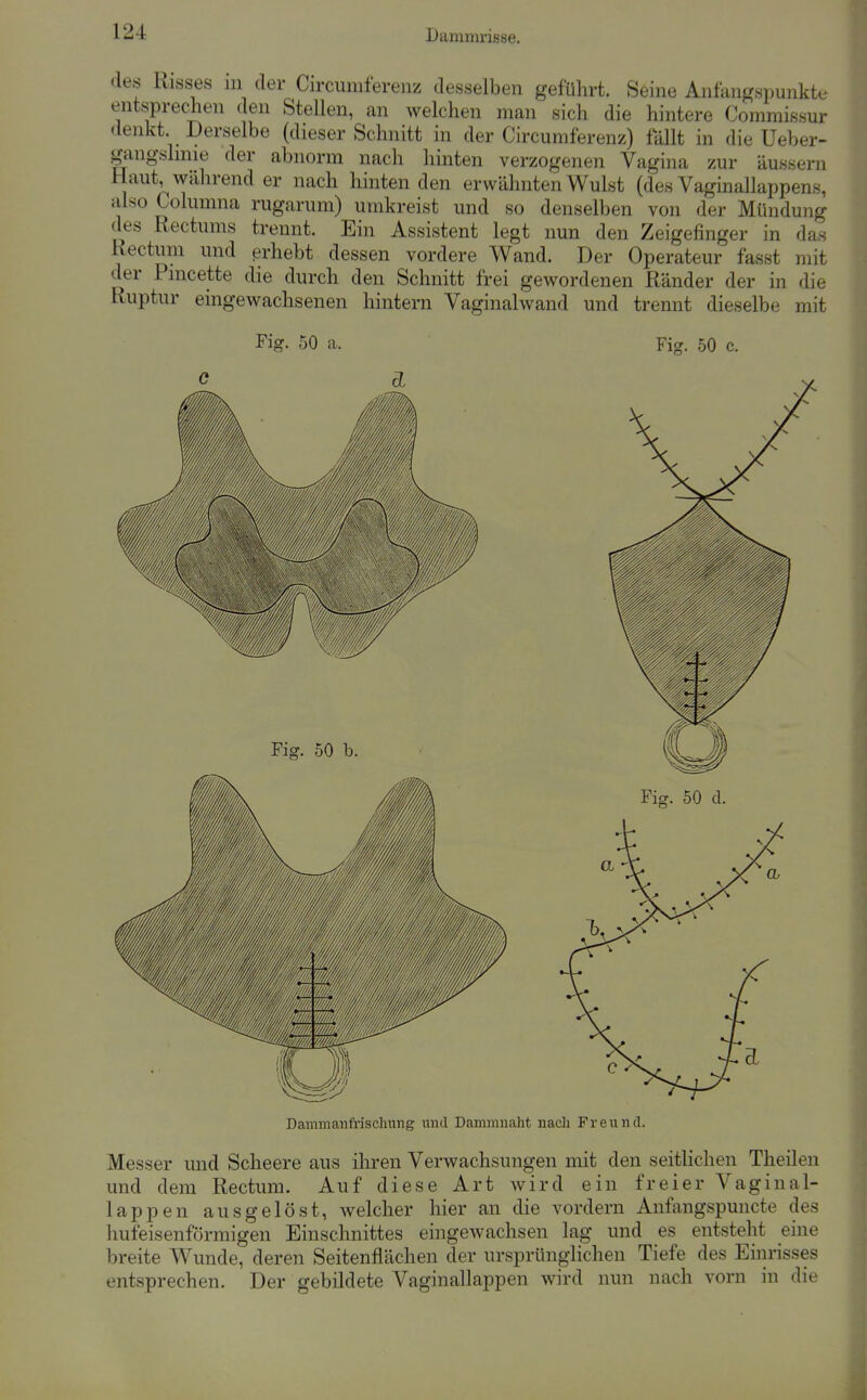 des Risses in der Circumferenz desselben geführt. Seine Anfangspunkte entsprechen den Stellen, an welchen man sich die hintere Commissur denkt. Derselbe (dieser Schnitt in der Circumferenz) fällt in die Ueber- gangslinie der abnorm nach hinten verzogenen Vagina zur äussern Haut, während er nach hinten den erwähnten Wulst (des Vaginallappens, also Columna rugarum) umkreist und so denselben von der Mündung des Rectums trennt. Ein Assistent legt nun den Zeigefinger in das Rectum und erhebt dessen vordere Wand. Der Operateur fasst mit der Pmcette die durch den Schnitt frei gewordenen Ränder der in die Ruptur eingewachsenen hintern Vaginalwand und trennt dieselbe mit Fig. 50 a. Fig. 50 c. Dammaiifrischung und Dammnaht nacli Freund. Messer und Scheere aus iliren Verwachsungen mit den seitlichen Theilen und dem Rectum. Auf diese Art wird ein freier Vaginal- lappen ausgelöst, welcher hier an die vordem Anfangspuiicte des hufeisenförmigen Einschnittes eingewachsen lag und es entsteht eine breite Wunde, deren Seitenflächen der ursprünglichen Tiefe des Einrisses entsprechen. Der gebildete Vaginallappen wird nun nach vorn in die