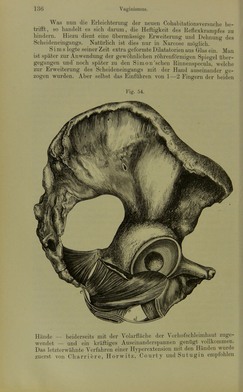 Was nun die Erleichterung der neuen Cohabitationsversuche be- trifft, so handelt es sich darum, die Heftigkeit des Reflexkrampfes zu hindern. Hiezu dient eine übermässige Erweiterung und Dehnung des Scheideneingangs. Natürlich ist dies nur in Narcose möglich, Sims legte seiner Zeit extra geformte Dilatatorien aus Grlas ein. Man ist später zur Anwendung der gewöhnlichen röhrenförmigen Spiegel über- gegangen und'noch später zu den Simon'sehen Rinnenspecula, welche zur Erweiterung des Scheideneingangs mit der Hand auseinander ge- zogen wurden. Aber selbst das Einführen von 1—2 Fingern der beiden Fig. 54. Hände — beiderseits mit der Volarfläche der Vorhofschleimhaut zuge- wendet — und ein kräftiges Auseinanderspannen genügt vollkommen. Das letzterwähnte Verfahren einer Hyperextension mit den Händen wurde zuerst von Charrifere, Horwitz, Courty und Sutugin empfohlen
