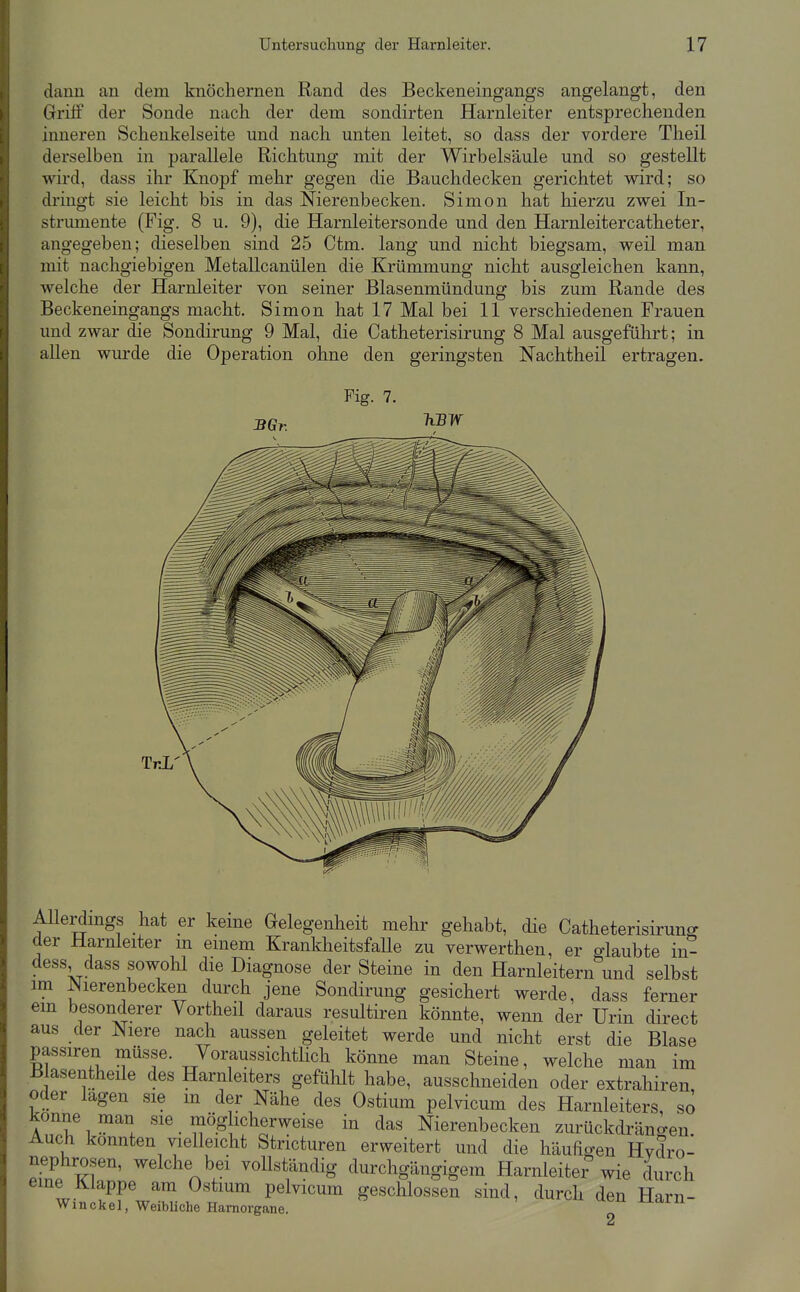 dann an dem knöchernen Rand des Beckeneingangs angelangt, den Griff der Sonde nach der dem sondirten Harnleiter entsprechenden inneren Schenkelseite und nach unten leitet, so dass der vordere Theil derselben in parallele Richtung mit der Wirbelsäule und so gestellt wird, dass ihr Knopf mehr gegen die Bauchdecken gerichtet wird; so dringt sie leicht bis in das Nierenbecken. Simon hat hierzu zwei In- strumente (Fig. 8 u. 9), die Harnleitersonde und den Harnleitercatheter, angegeben; dieselben sind 25 Ctm. lang und nicht biegsam, weil man mit nachgiebigen Metallcanülen die Krümmung nicht ausgleichen kann, welche der Harnleiter von seiner Blasenmündung bis zum Rande des Beckeneingangs macht. Simon hat 17 Mal bei 11 verschiedenen Frauen und zwar die Sondirung 9 Mal, die Catheterisirung 8 Mal ausgeführt; in allen wurde die Operation ohne den geringsten Nachtheil ertragen. Fig. 7. 3Gr. Allerdmgs hat er keine Gelegenheit mehr gehabt, die Catheterisirung der Harnleiter m einem KrankheitsfaUe zu verwerthen, er o-kubte in- dess dass sowohl die Diagnose der Steine in den Harnleitern^'und selbst im Nierenbecken durch jene Sondirung gesichert werde, dass ferner em besonderer Vortheil daraus resultiren könnte, wenn der Urin direct aus der Niere nach aussen geleitet werde und nicht erst die Blase passiren müsse. Voraussichtlich könne man Steine, welche man im Blasentheile des Harnleiters gefühlt habe, ausschneiden oder extrahiren oder lagen sie m der Nähe des Ostium pelvicum des Harnleiters, so könne man sie mög icherweise in das Nierenbecken zurückdräno-en Auch konnten vielleicht Stricturen erweitert und die häufigen Hvdro- nephrosen, welche bei vollständig durchgängigem Harnleiter wie durch eme Klappe am Ostium pelvicum geschlossen sind, durch den Harn- Winckel, Weibliche Hamorgane.