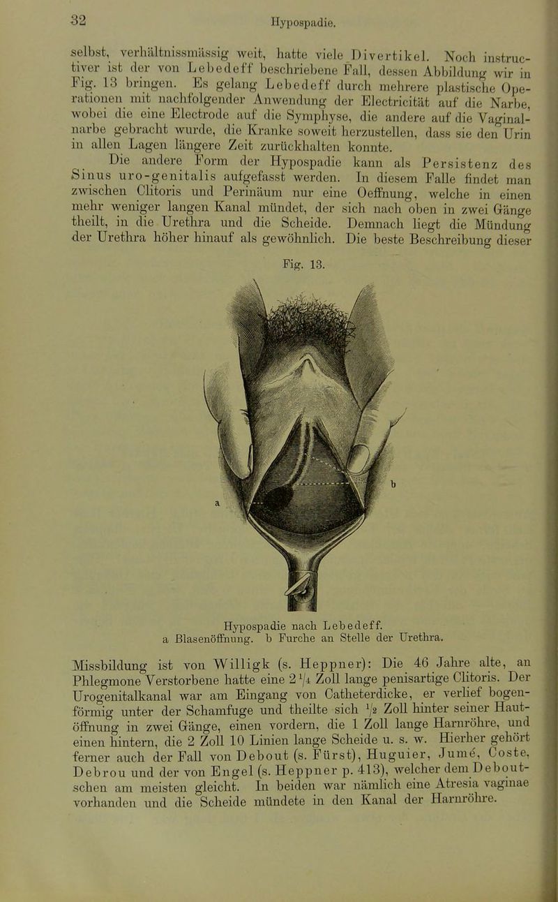 Hypospadie. selbst, verhältnissmässig weit, hatte viele Divertikel. Noch instmc- tiver ist der von Lebedeff beschriebene Fall, dessen Abbildung wir in Fig. 13 bringen. Es gelang Lebedeff durch mehrere plastische Ope- rationen mit nachfolgender Anwendung der Electricität auf die Narbe, wobei die eine Electrode auf die Symphyse, die andere auf die Vaginal- iiarbe gebracht wurde, die Kranke soweit herzustellen, dass sie den Urin in allen Lagen längere Zeit zurückhalten konnte. Die andere Form der Hypospadie kann als Persistenz des Sinus uro-genitalis aufgefasst werden. Li diesem Falle findet man zwischen Chtoris und Perinäum nur eine OefiPnung, welche in einen mehr weniger langen Kanal mündet, der sich nach oben in zwei Gänge theilt, in die Urethra und die Scheide. Demnach liegt die Mündung der Urethra höher hinauf als gewöhnhch. Die beste Beschreibung dieser Fig. 13. Hypospadie nach Lebedeff. a ßlasenöffiiung. b Furclie an Stelle der Urethra. Missbildung ist von Willigk (s. Heppner): Die 46 Jahre alte, an Phlegmone Verstorbene hatte eine 2 Zoll lange penisartige Clitoris. Der Urogenitalkanal war am Eingang von Catheterdicke, er verlief bogen- förmig unter der Schamfuge und theilte sich ^2 Zoll hinter seiner Haut- öffnung in zwei Gränge, einen vordem, die 1 Zoll lange Harnröhre, und einen hintern, die 2 Zoll 10 Linien lange Scheide u. s. w. Hierher gehört ferner auch der Fall vonDebout (s. Fürst), Huguier, Jume, Coste, Debrou und der von Engel (s. Heppner p. 413), welcher dein Debout- schen am meisten gleicht. In beiden war näniHch eine Atresia vagmae vorhanden und die Scheide mündete in den Kanal der Harnröhre.